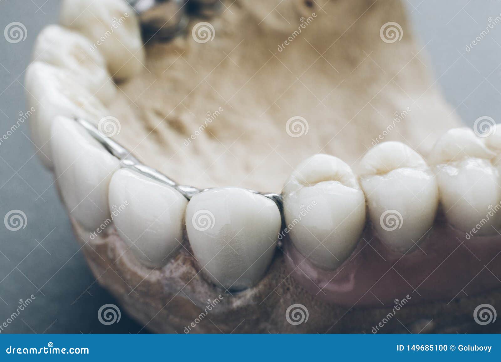 Dentistry Implantation Jaw Mold Artificial Denture Stock Photo Image