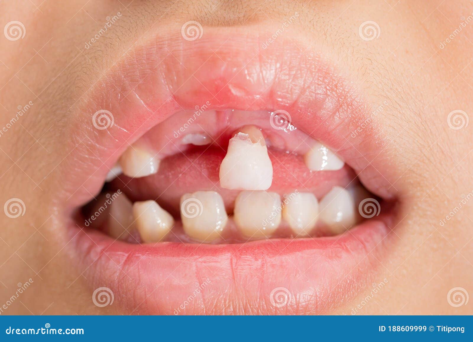 Dents De Lait Qui Sont Sur Le Point De Tomber Image stock - Image du  dentiste, santé: 188609999