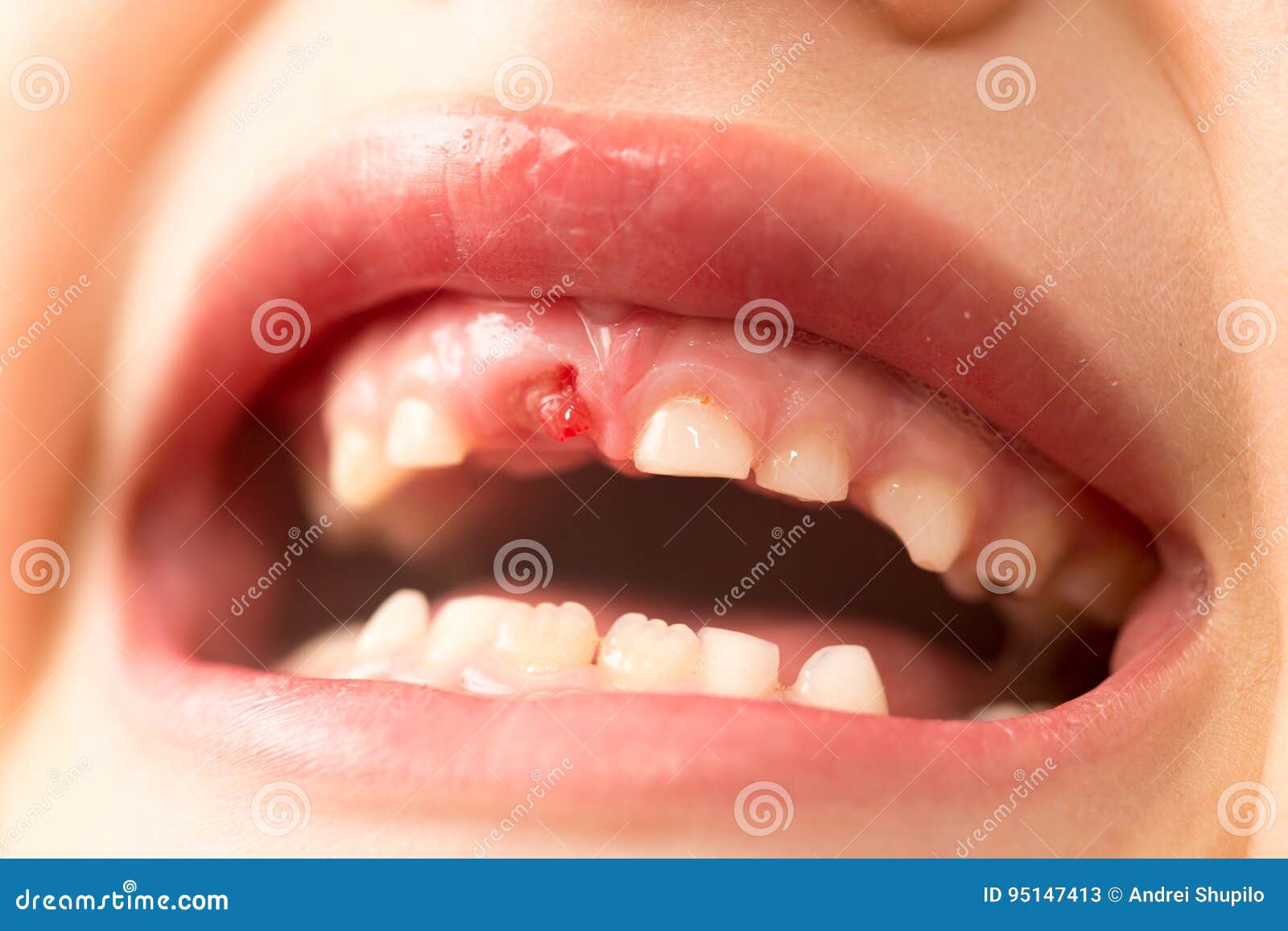 mund ohne zähne