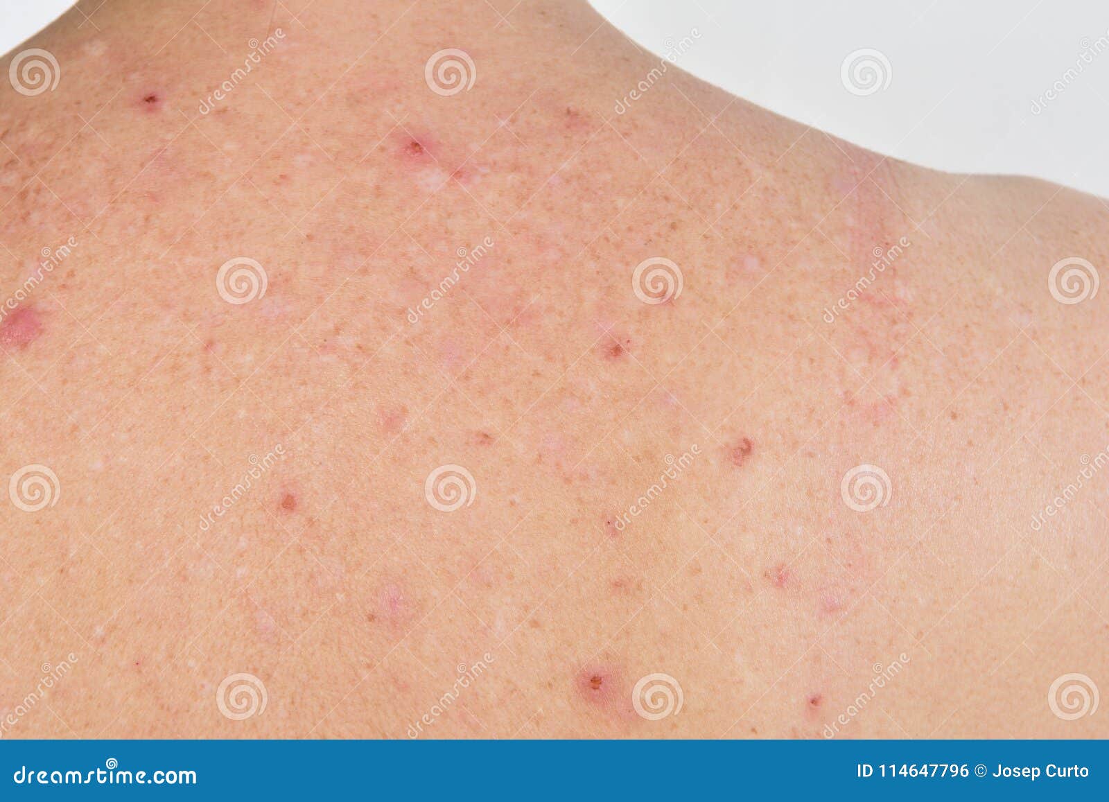 Dermatitis on the Back of a Stock Photo Image of close, itchy 114647796