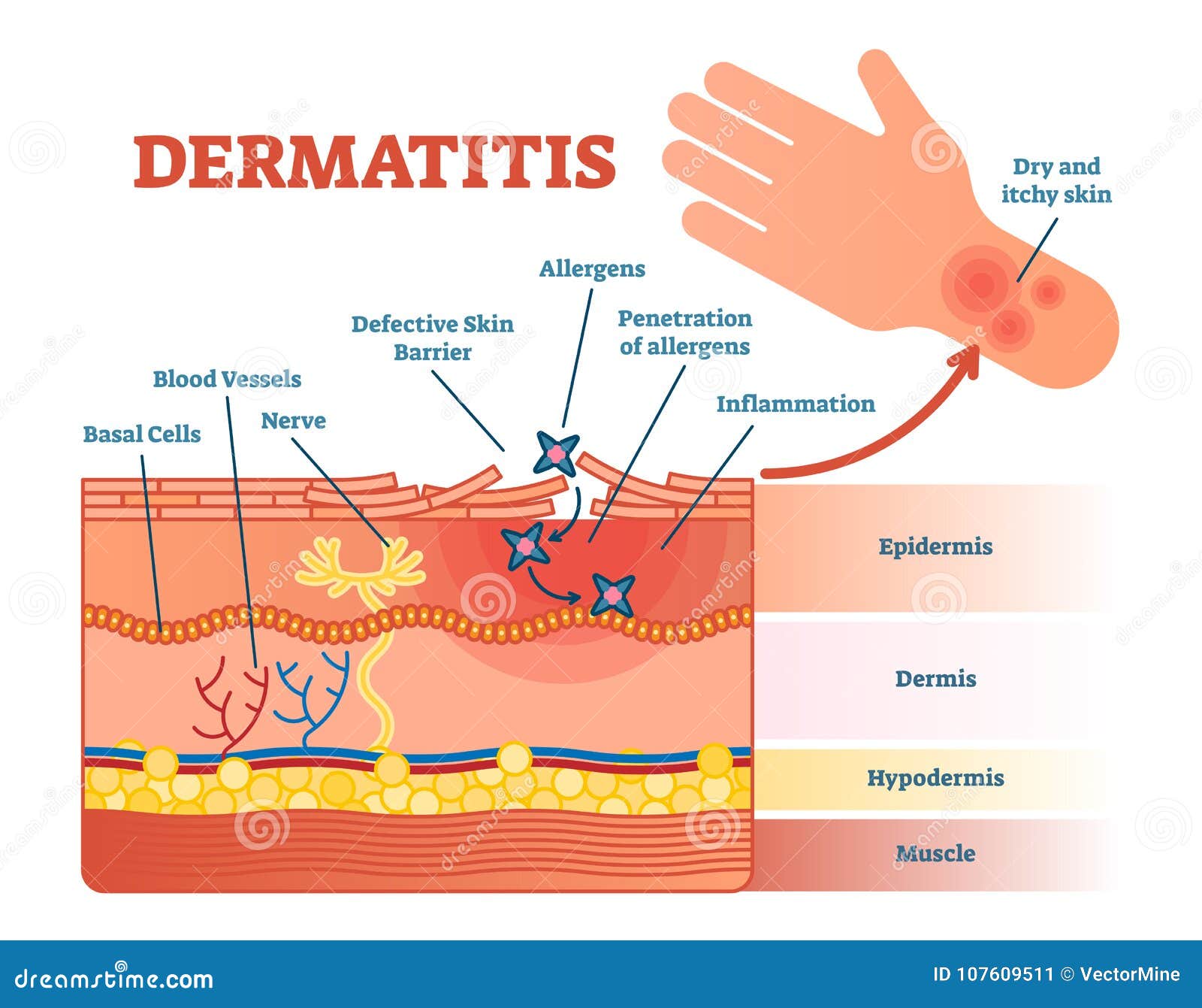 dermatitis flat   diagram with skin layers and allergen movement. educational medical information.