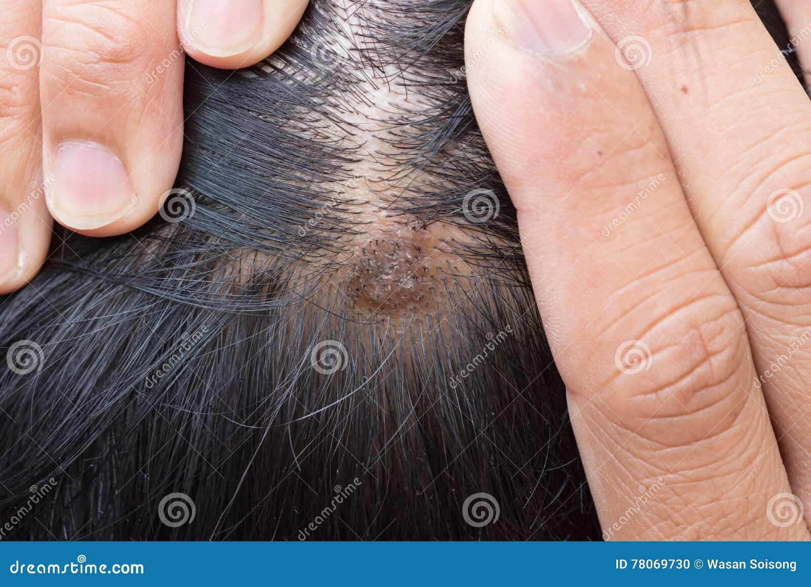 What is Seborrhoeic Dermatitis  Fulham Scalp and Hair Clinic