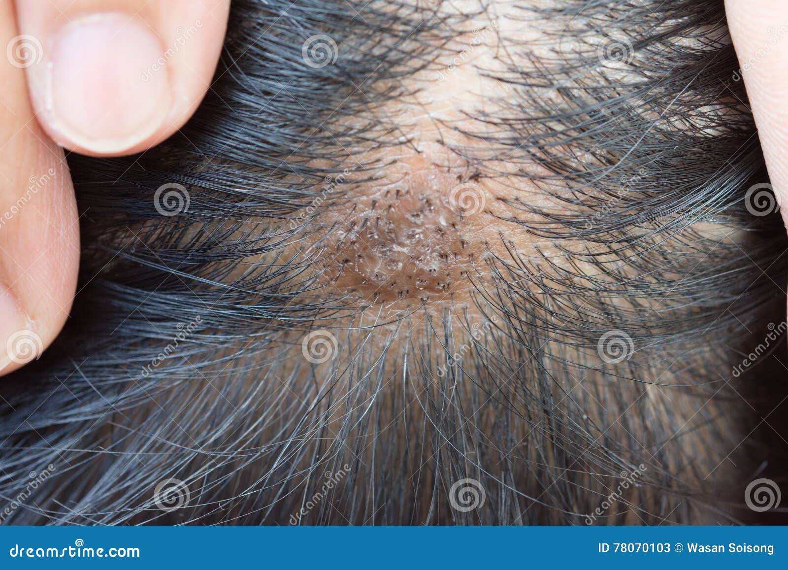 Dermatitis in Hair or Skin Disease on the Head Stock Image - Image of  dandruff, medical: 78070103