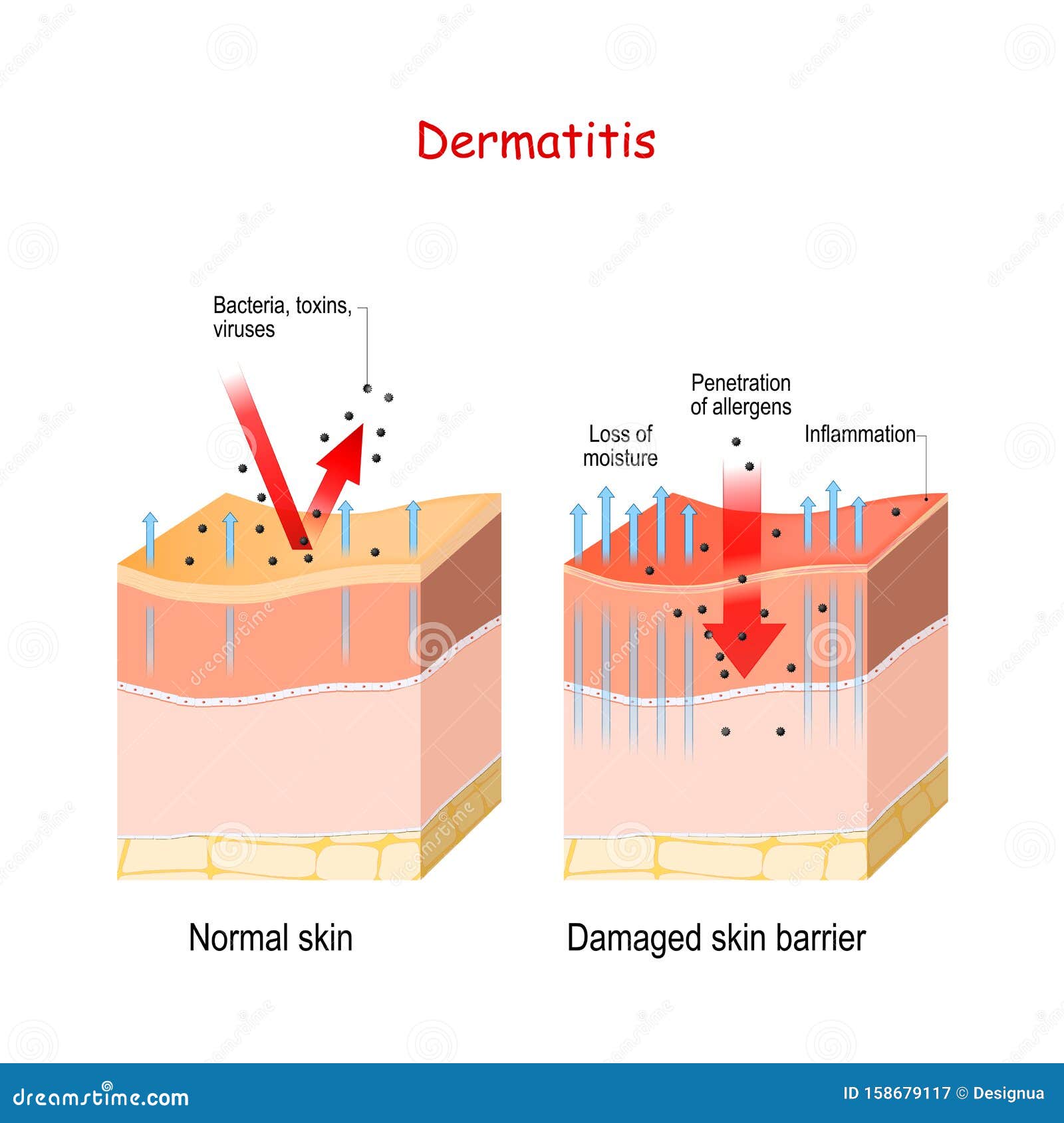 dermatitis. normal and skin with damaged barrier. protection effect