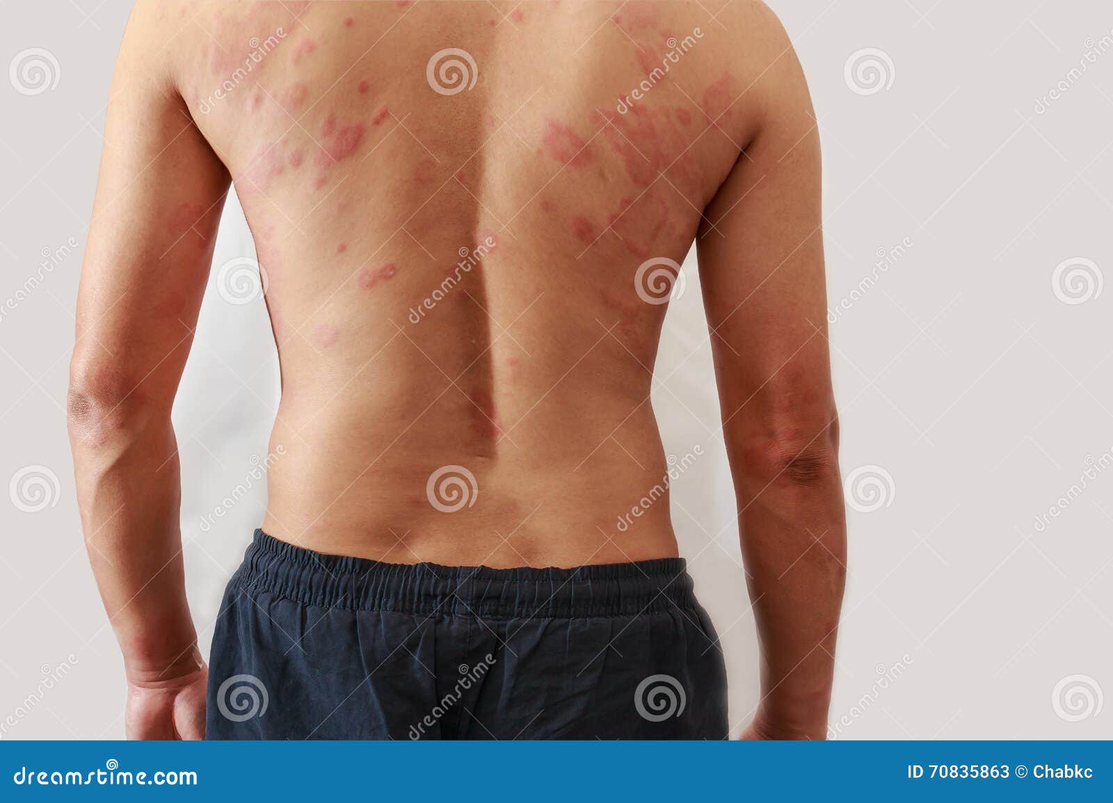 dermatitis problem of rash ,allergy rash