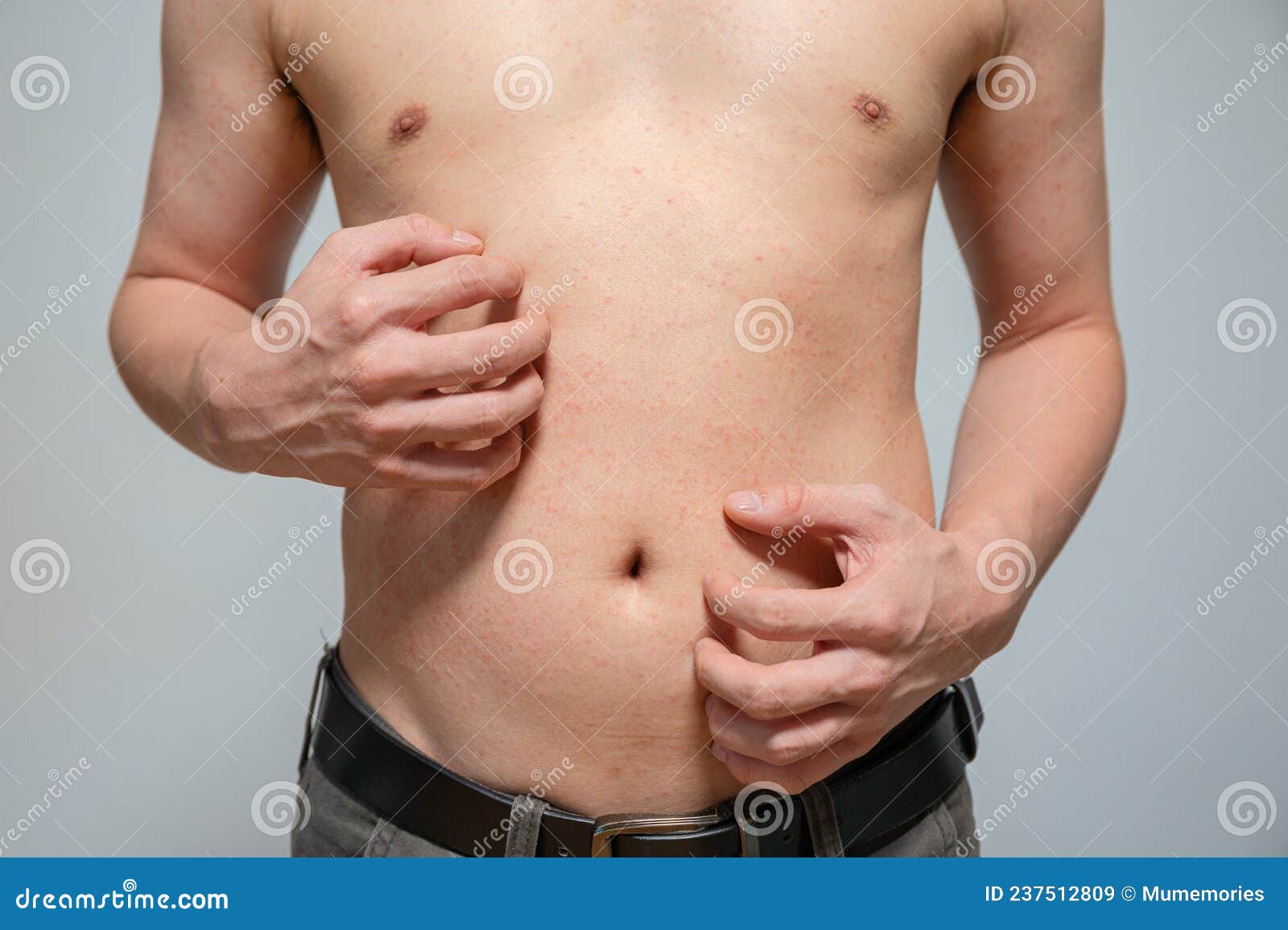 Dermatitis Rash Viral Disease with Immunodeficiency on Body of Young Adult  Asian, Scratching with Itching Stock Image - Image of allergic, contagious:  237512809
