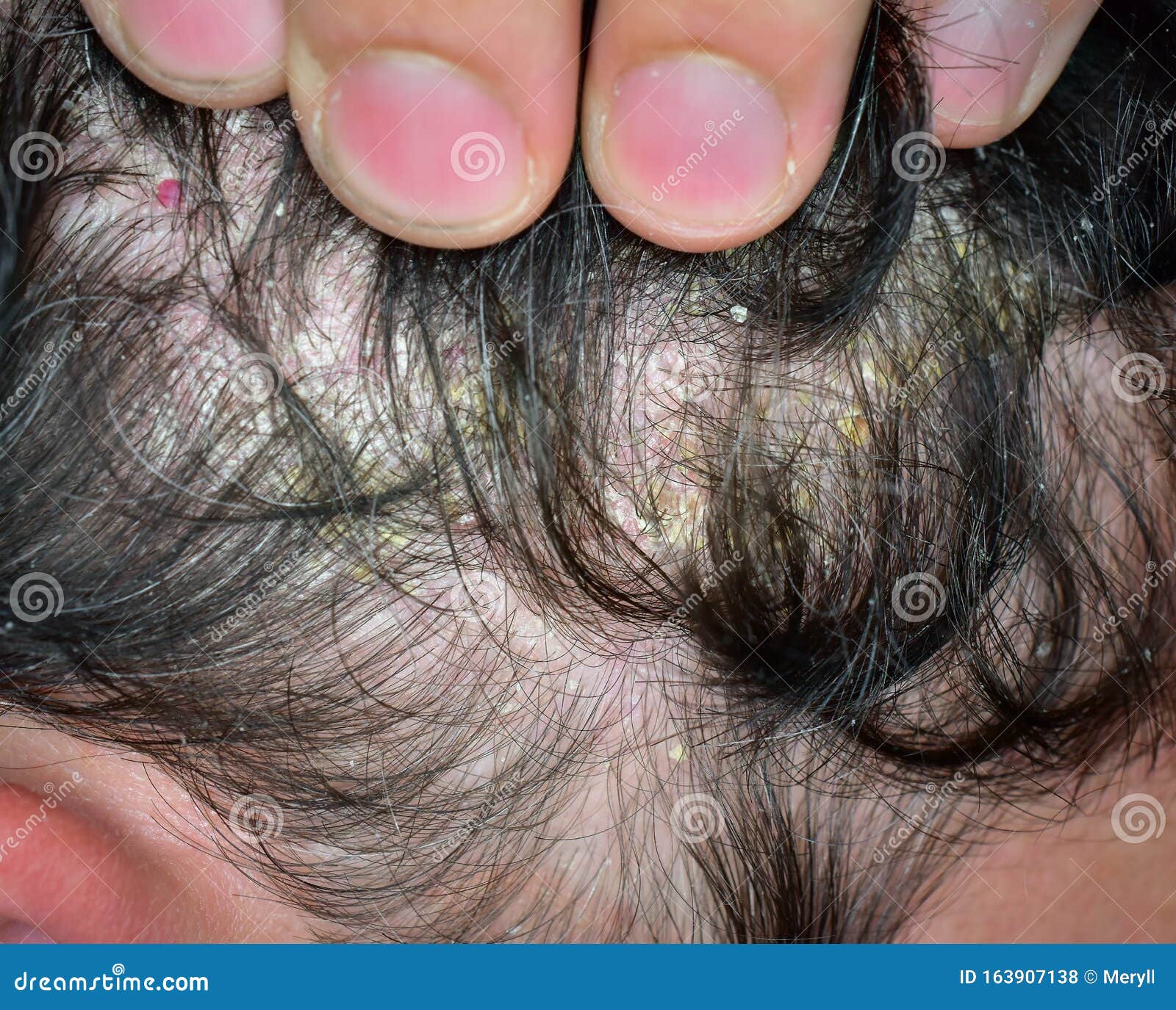 Dermatitis Seborrhoica Eczema Stock Photo - Image of itching, medical:  163907138