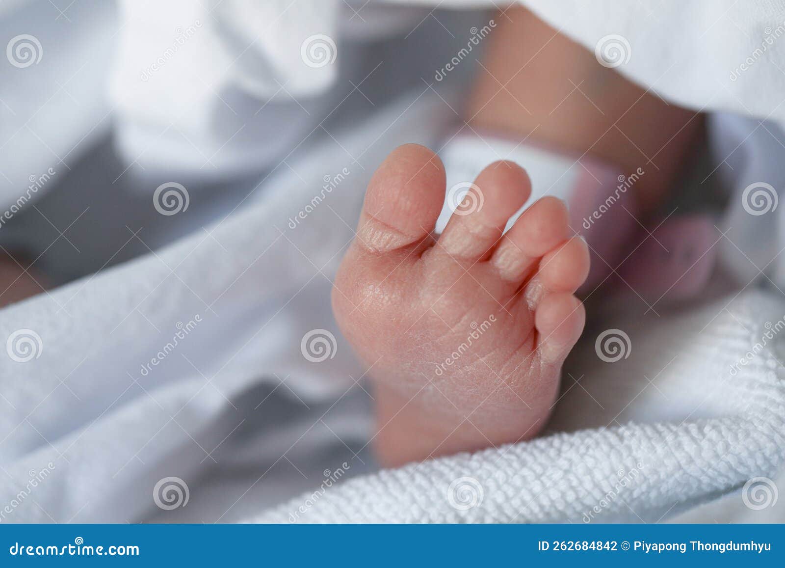 Dermatitis Small Warty Bumps Appear on the Skin in Child. Stock Photo