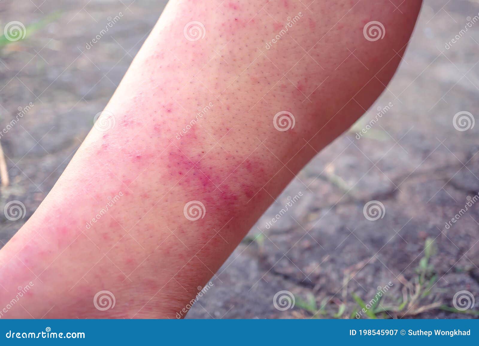 dermatitis and vesicles, dermatitis from measles virus, dermatitis due to urticaria, health problems, allergies, redness on the le
