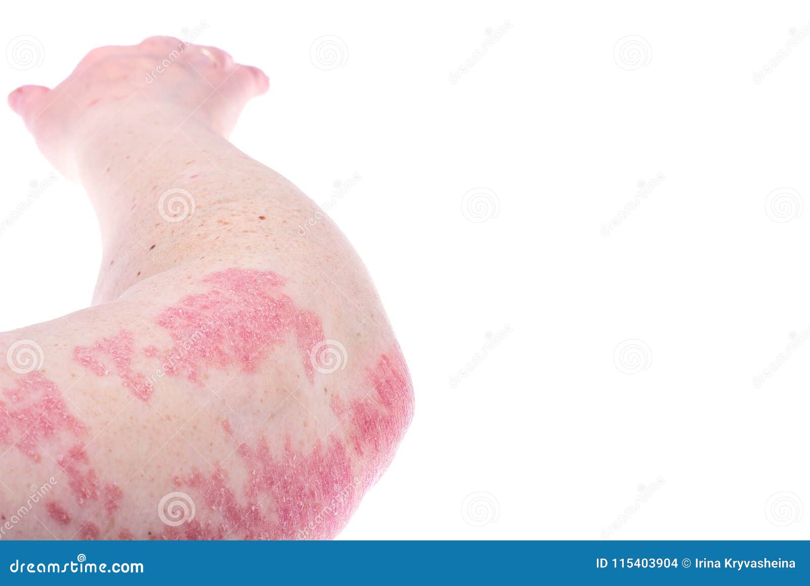 Dermatological Skin Disease Psoriasis More Pronounced On Elbow Hand