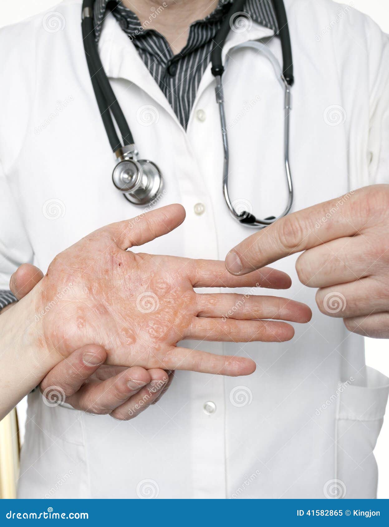 dermatologist examining hand with severe eczema