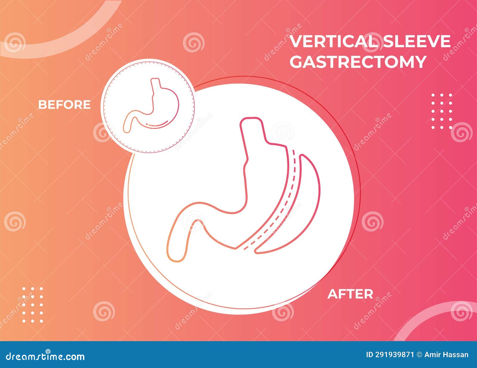 Laparoscopic Sleeve Gastrectomy, Vertical Gastrectomy, Weight Loss