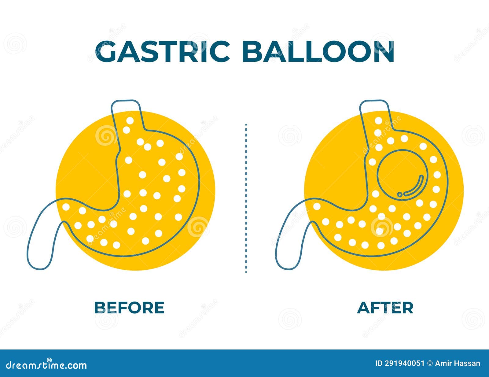 Stomach Endoscopy Gastric Balloon Inside A Stomach Weight Loss Surgery stomach-endoscopy-gastric-balloon-inside-a-stomach-weight-loss-surgery