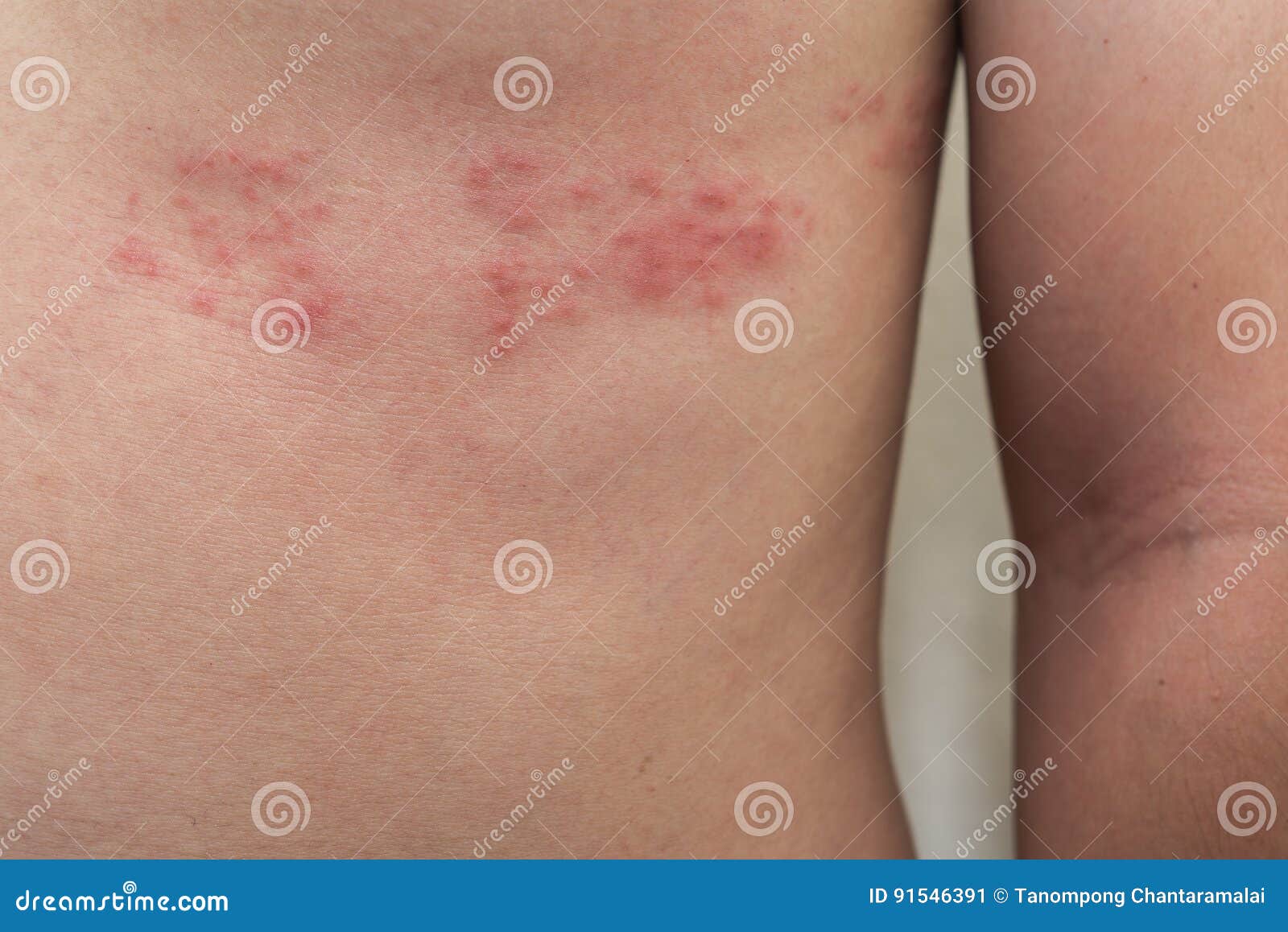 detail of body skin with herpes zoster shingles