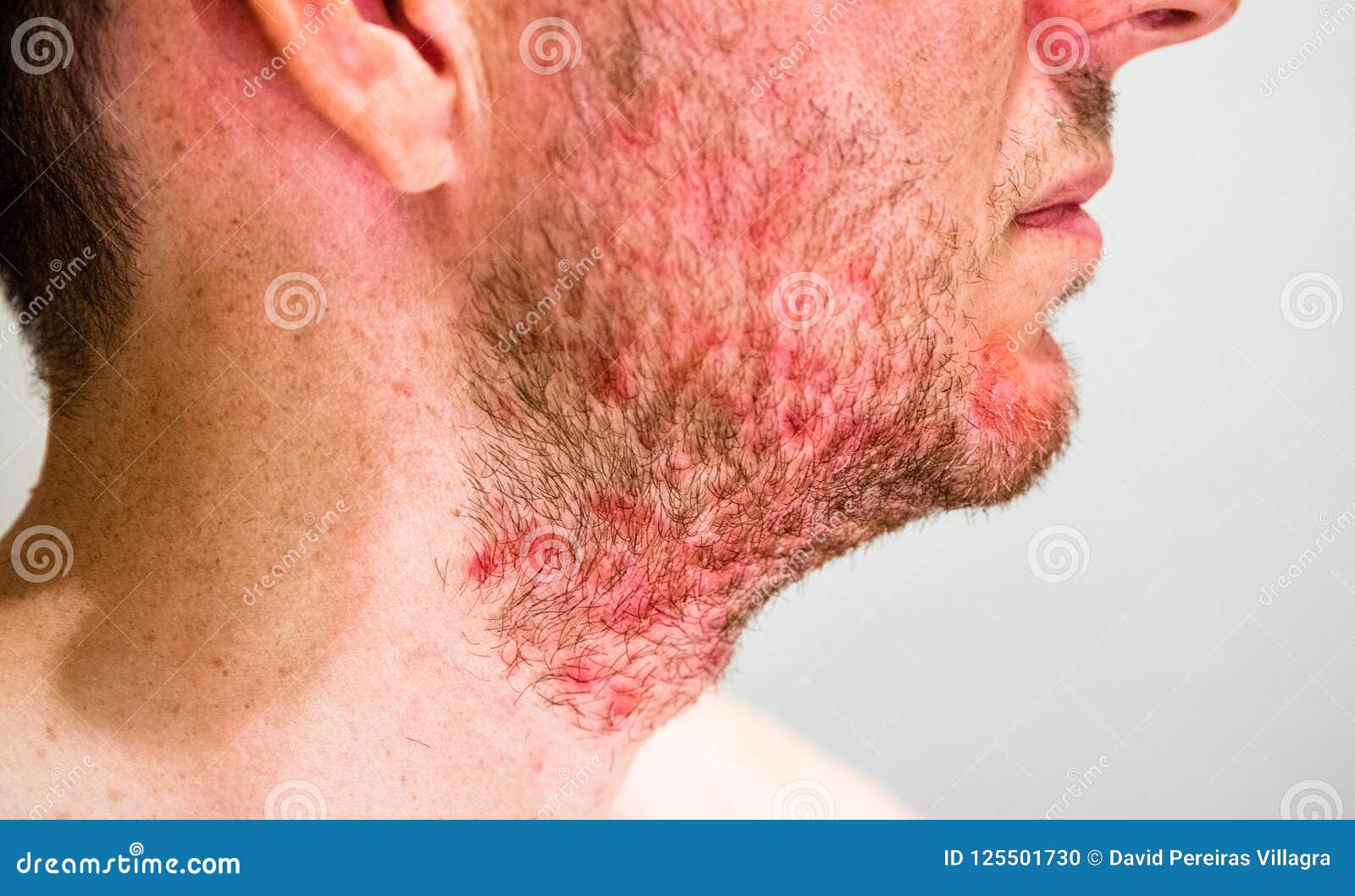 Man with Seborrheic Dermatitis in the Beard Area Stock Photo - Image of ...