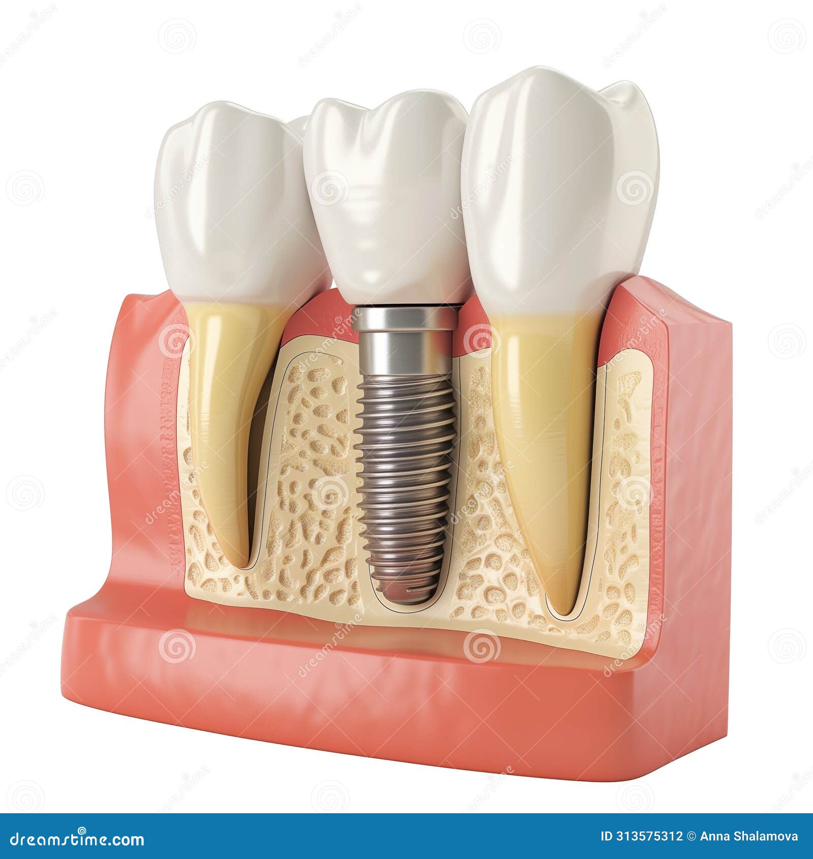 detailed medical  of a dental implant in the jawbone.