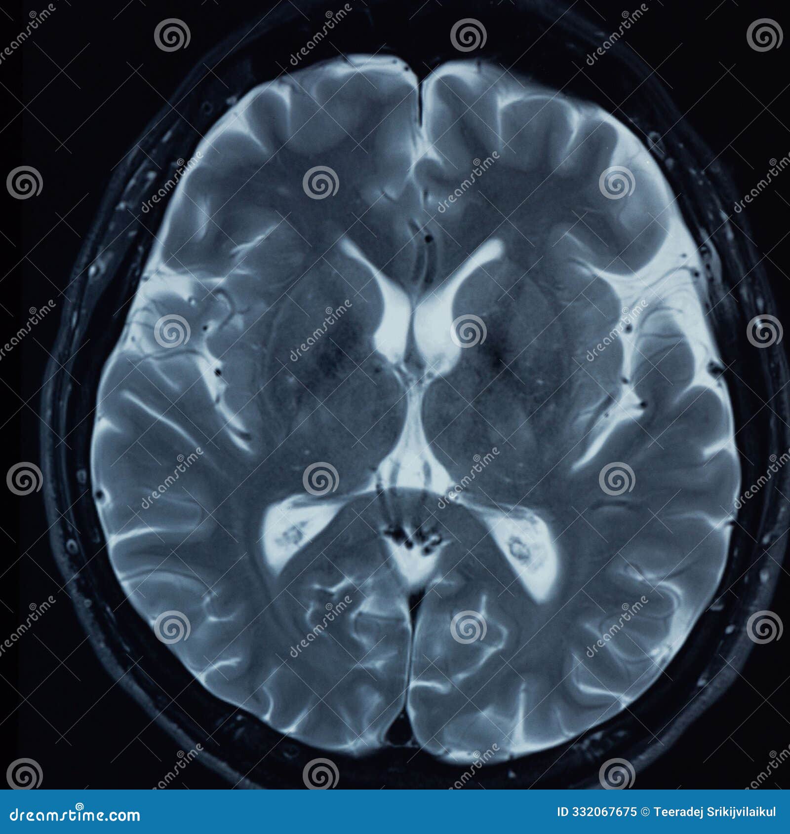 brain mri t2-weighted imaging