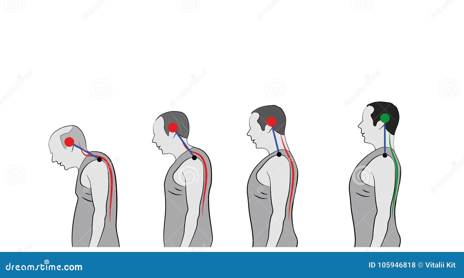 Development of a Stooped Stance with Age, Showing Increasing Curvature