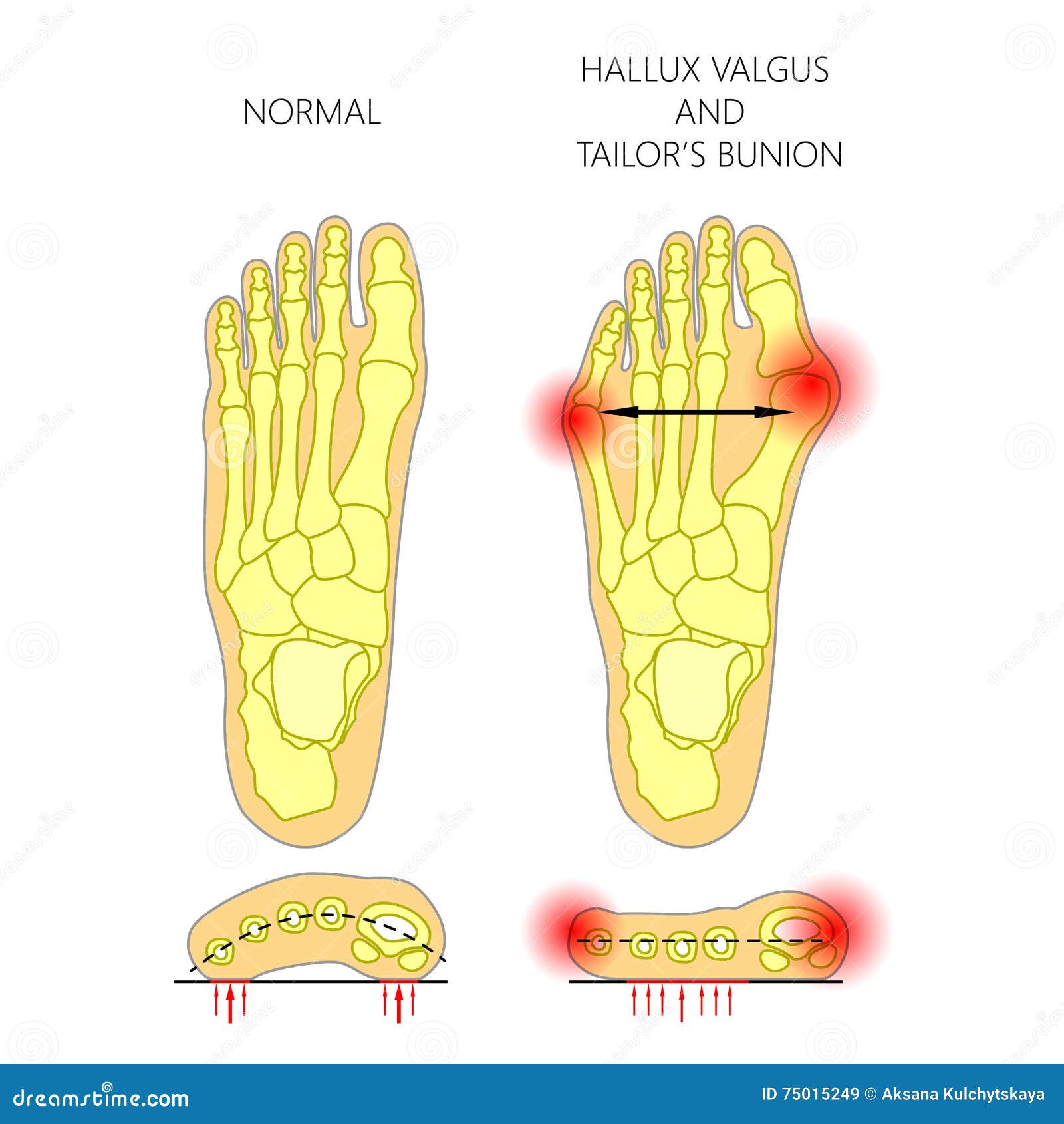 deviation of the first and the fifth metatarsals transverse flat