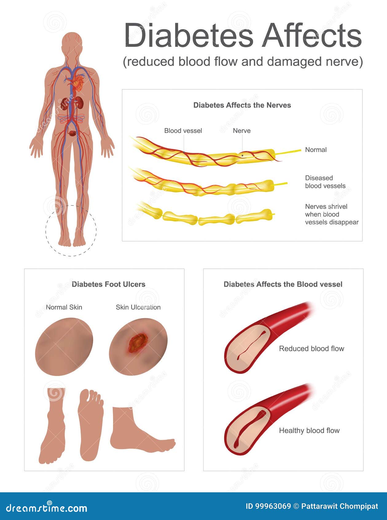 diabetes affects the nerves and vessels.