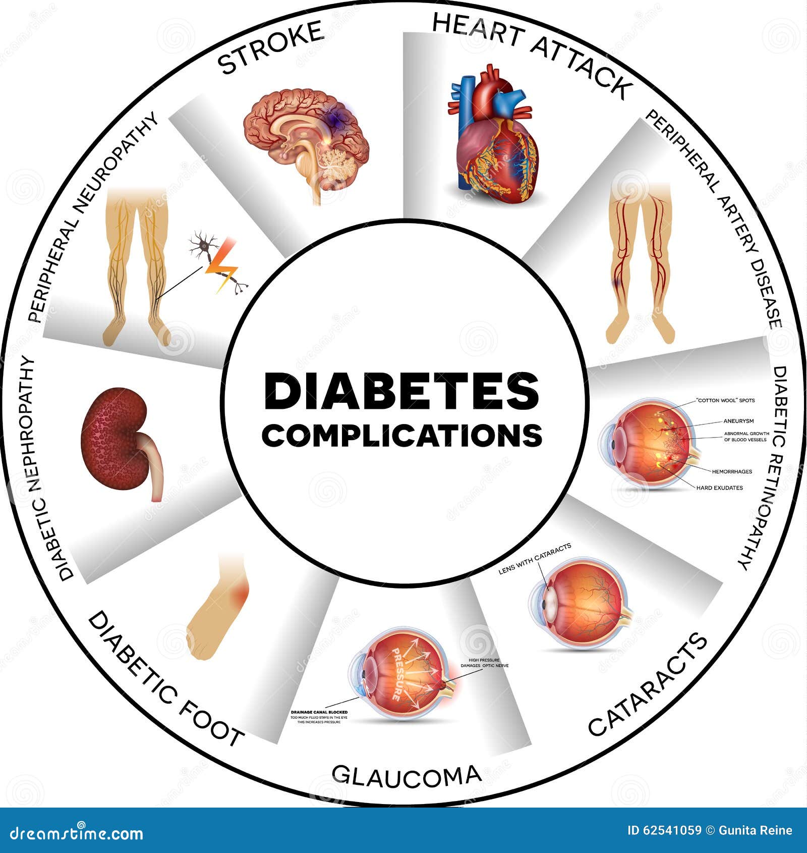 Diabetes complications stock illustration. Illustration of anatomy