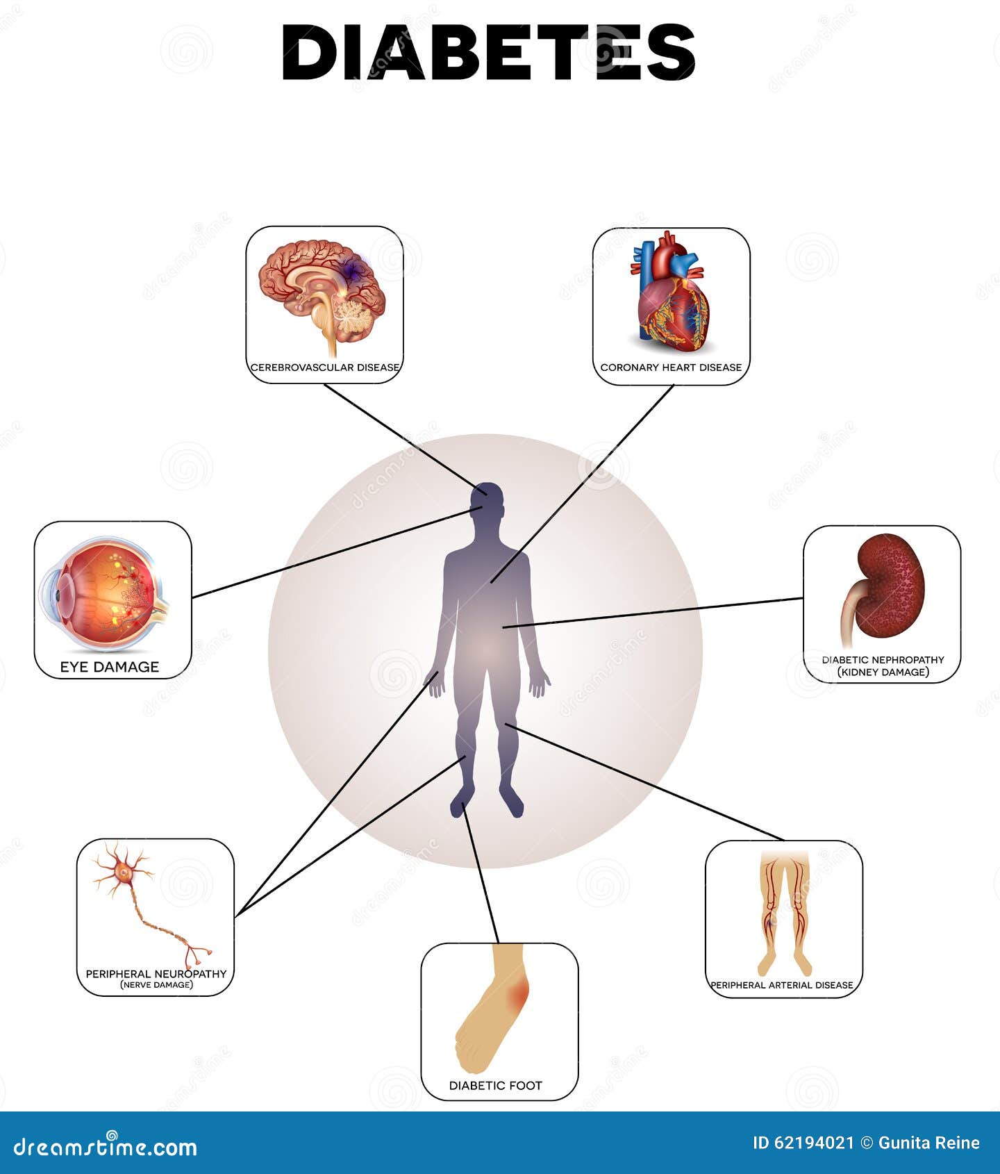 diabetes mellitus 2 zab kezelése)