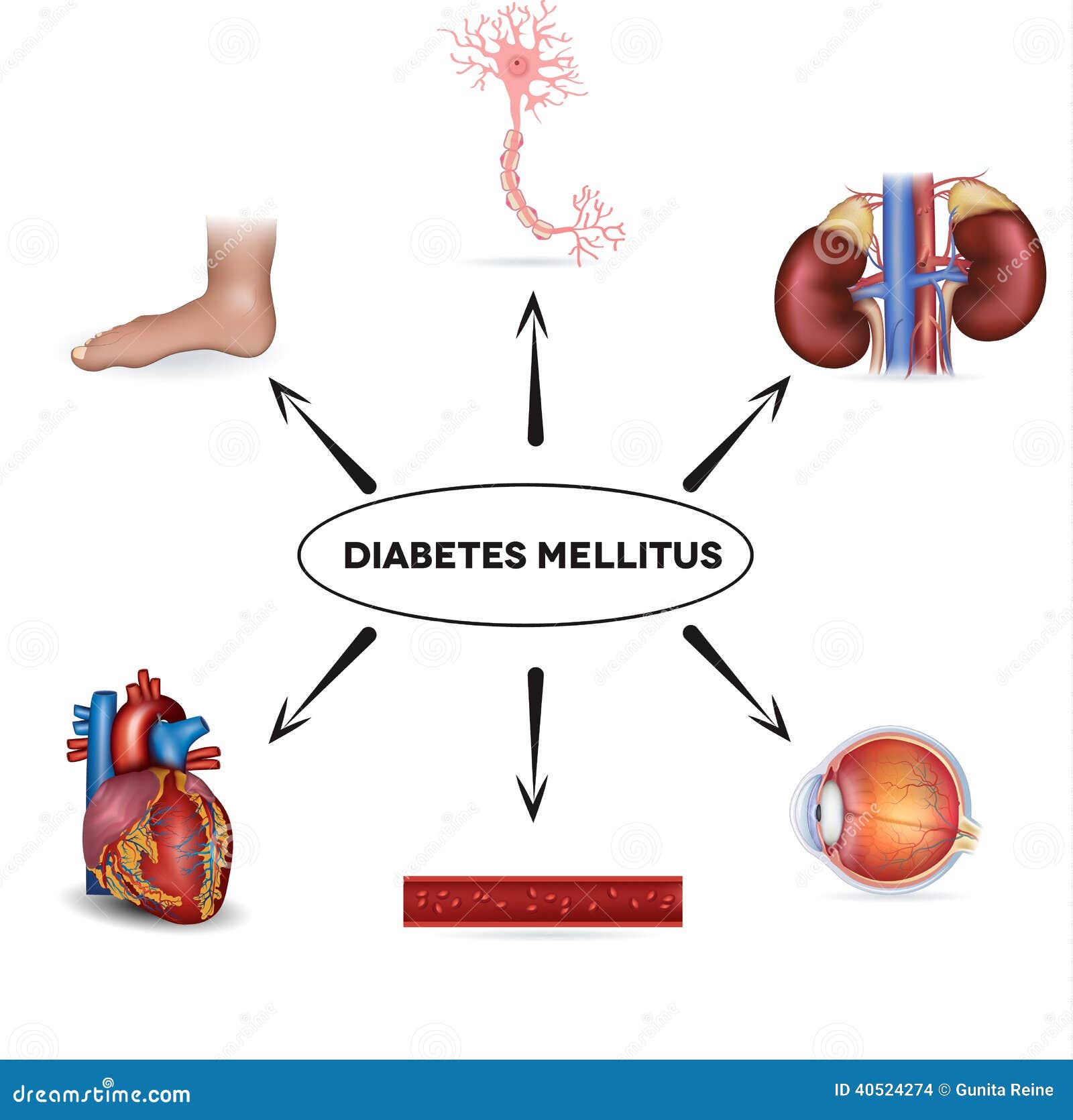 Diabetes Mellitus Animation