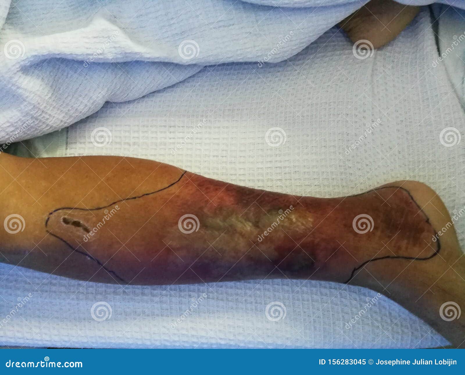 a diabetes patient resting on bed and with the leg swelling and redness symptoms.