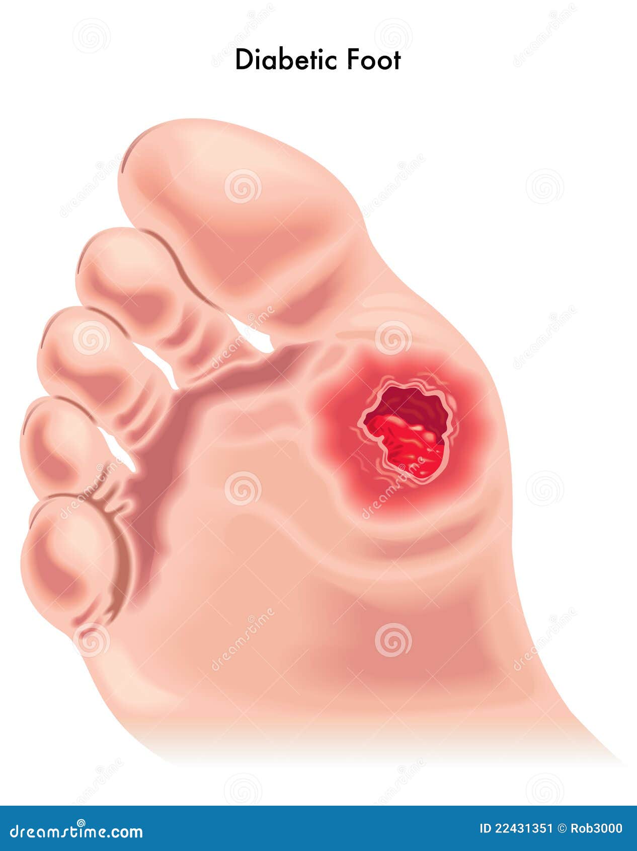 diabetic foot