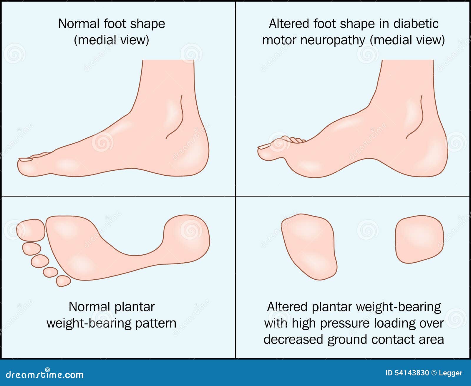 diabetic foot