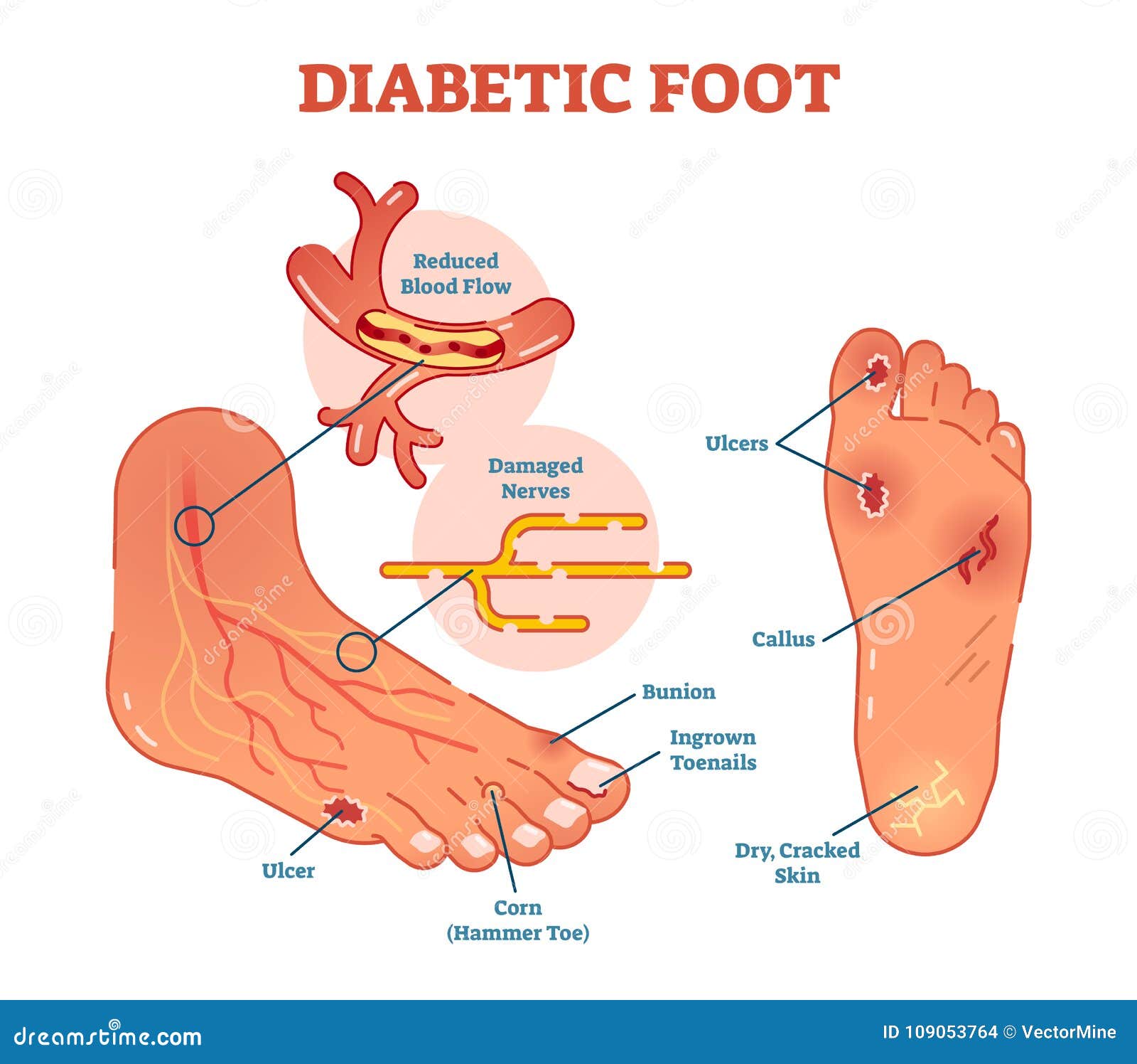 diabetic foot medical   scheme.