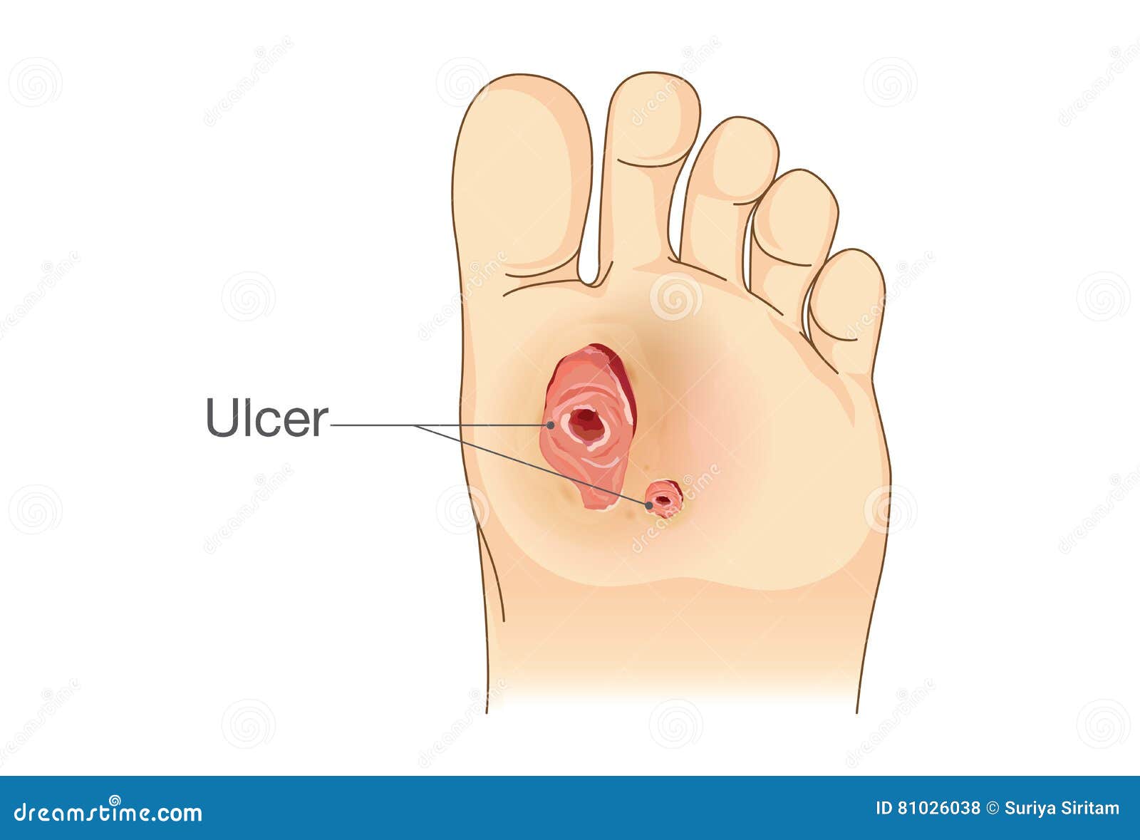 diabetic foot pain and ulcers.