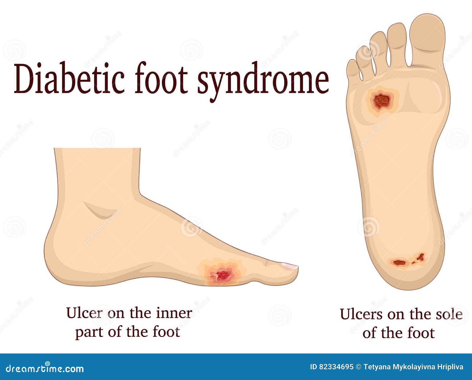 diabetic foot syndrome