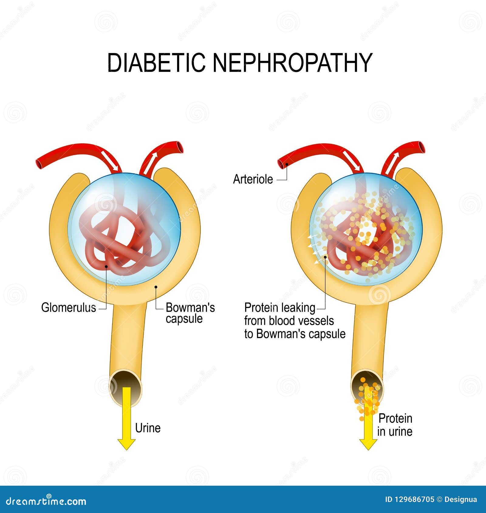 diabetic nephropathy. diabetic kidney disease
