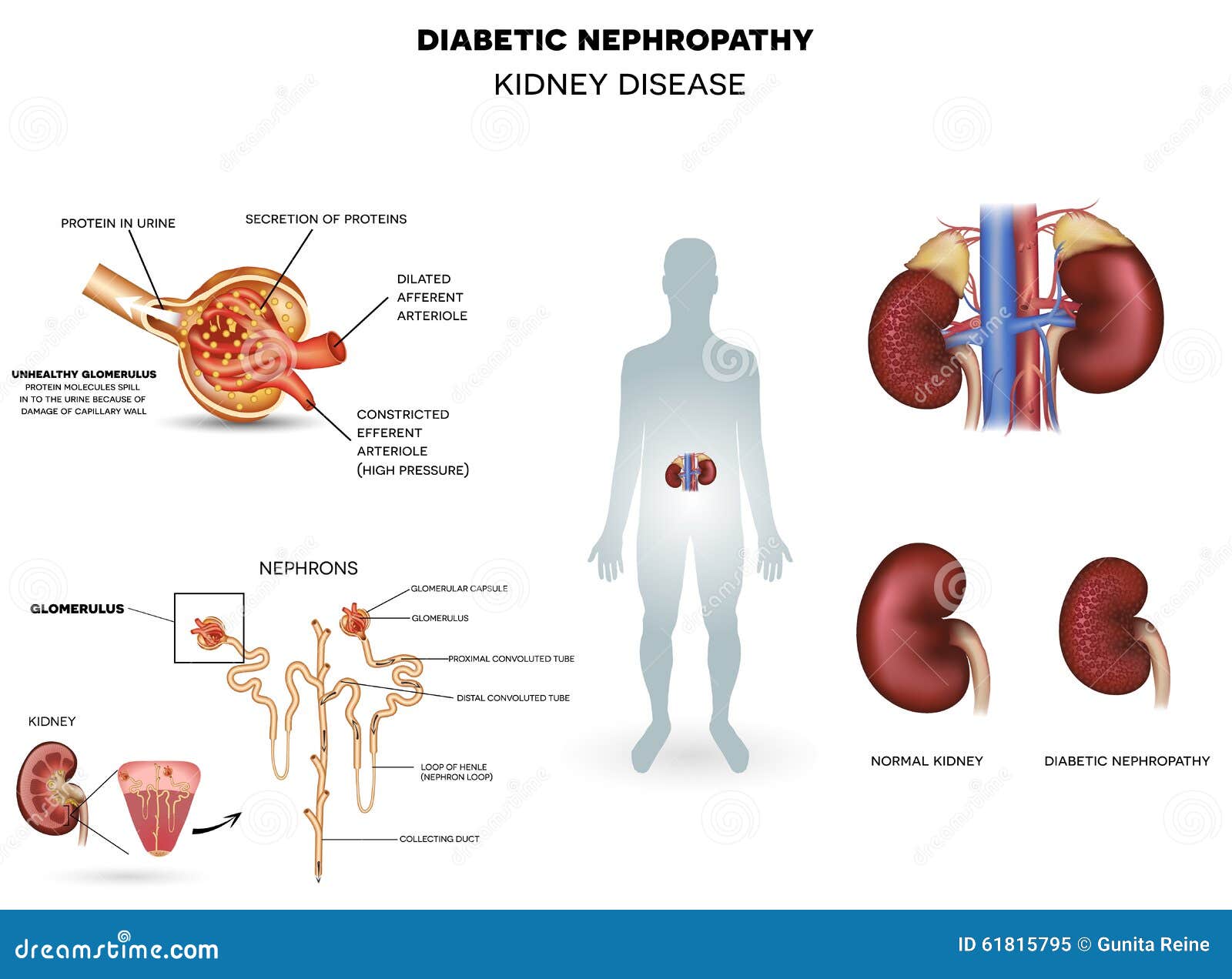 diabetic nephropathy, kidney disease