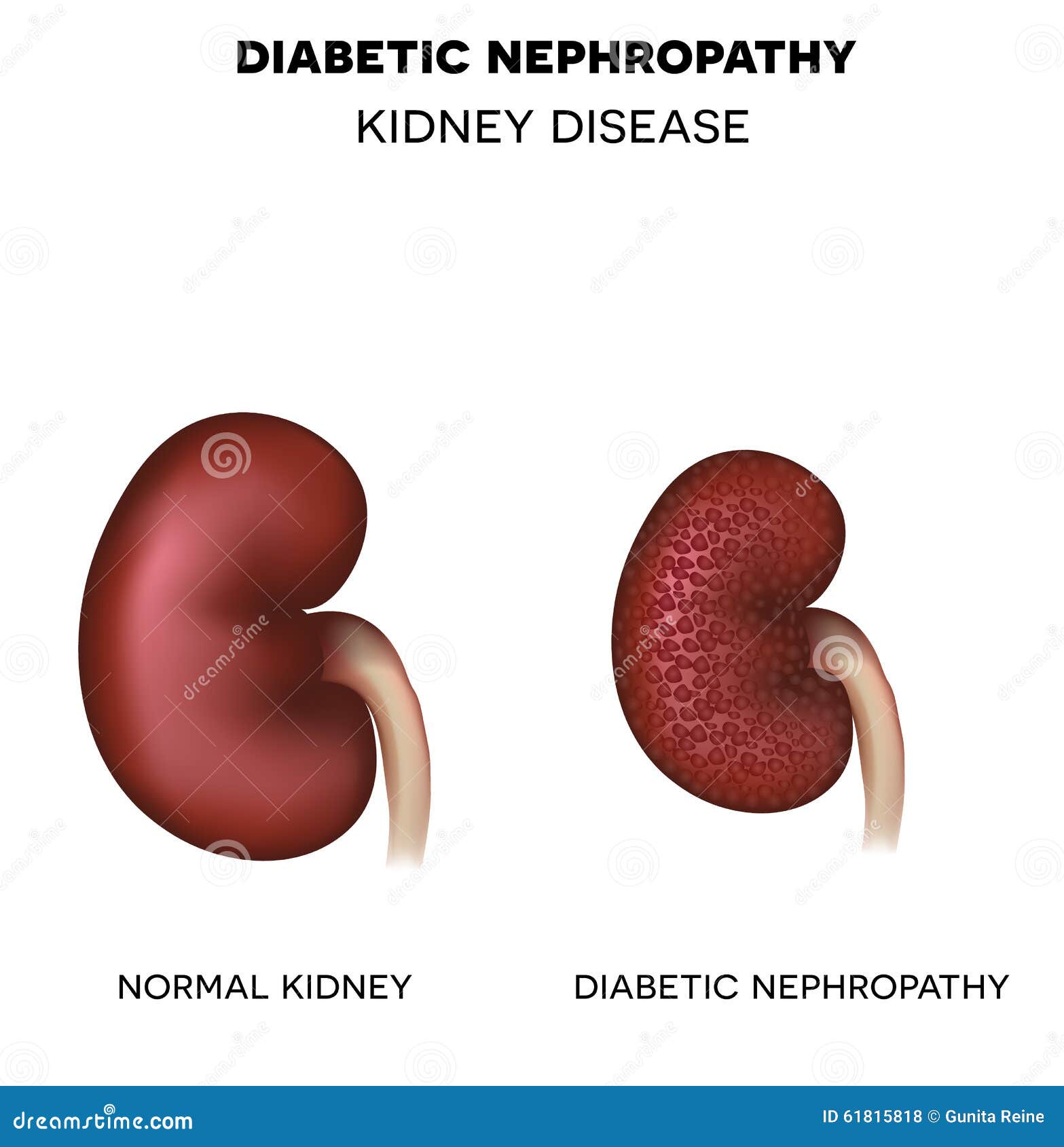 diabetic nephropathy, kidney disease