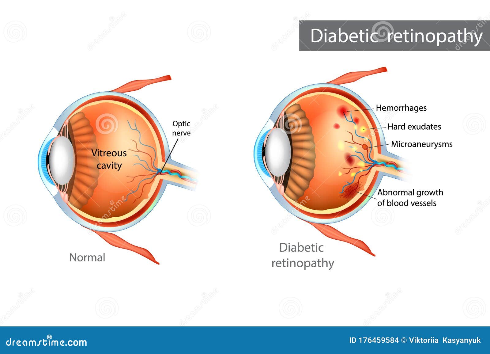 diabetic retinopathy. difference between normal retina and diabetic retinopathy