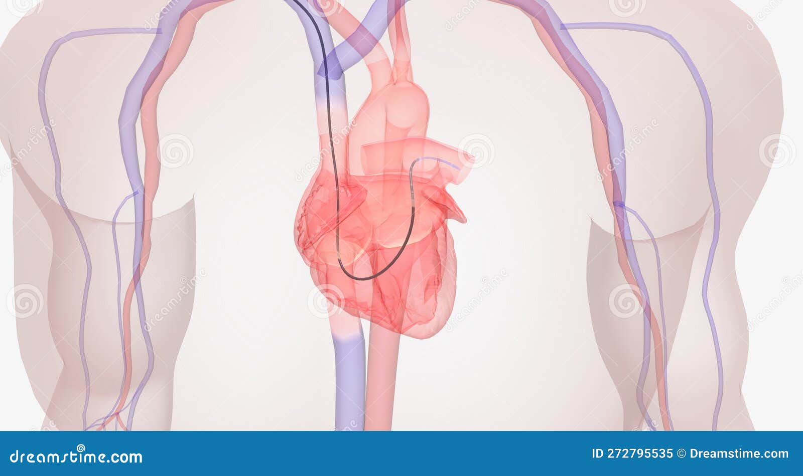 The Diagnostic Right Heart Catheterization Stock Illustration