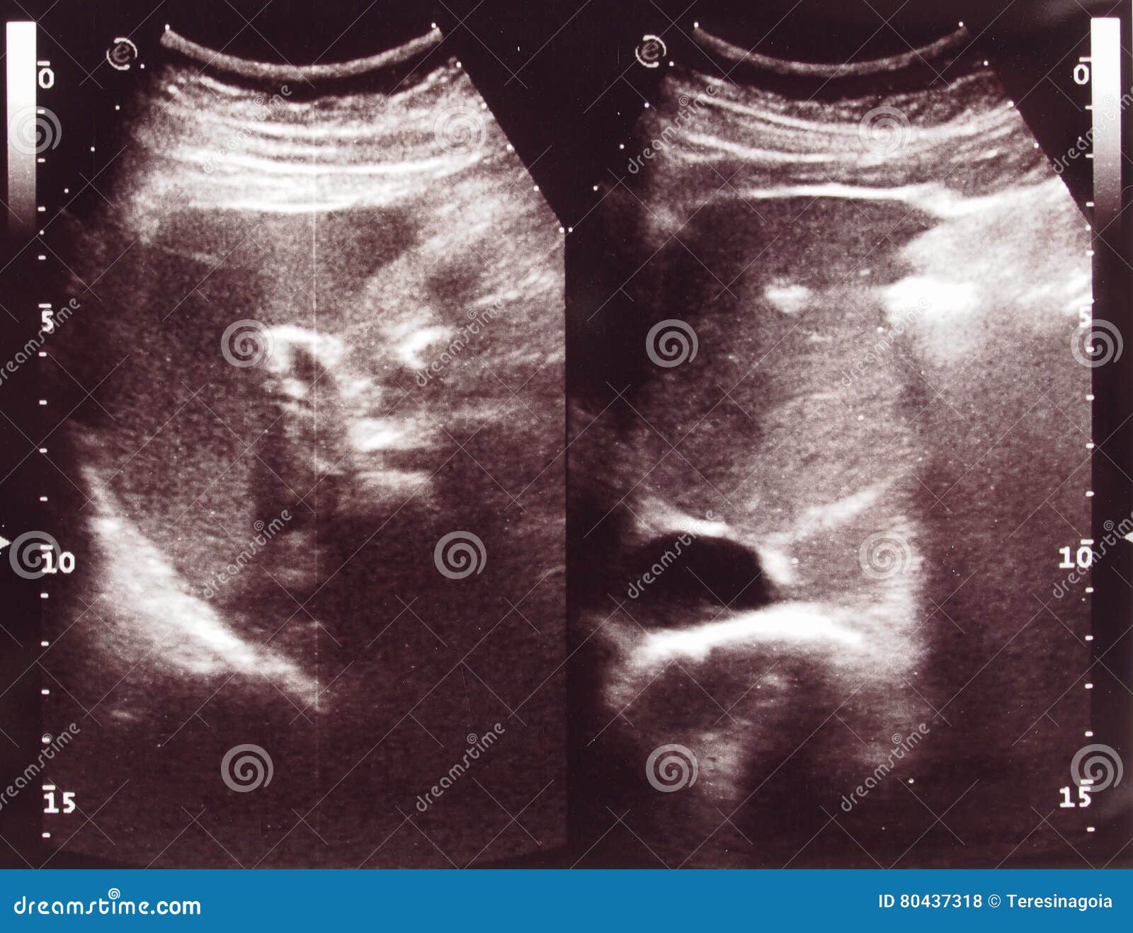 diagnostic sonography of abdomen