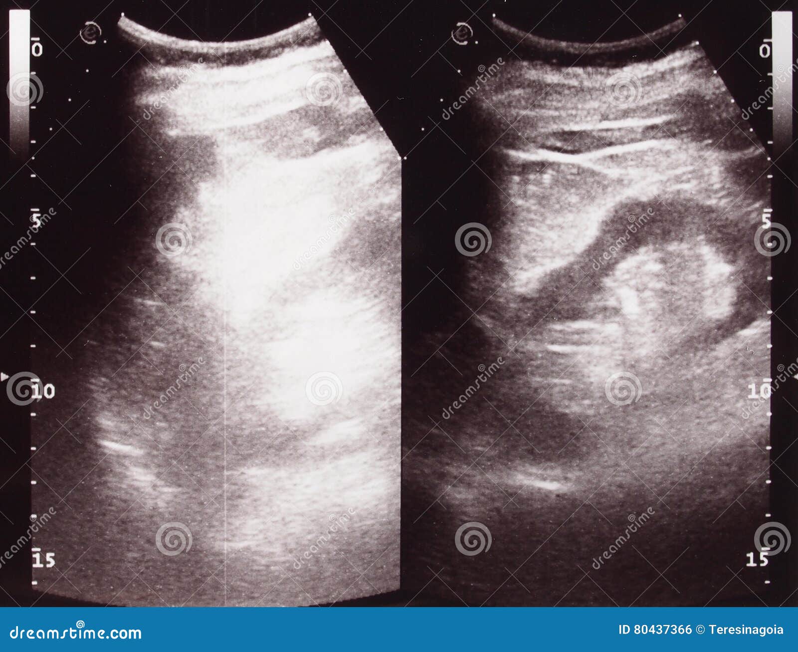 diagnostic sonography of abdomen