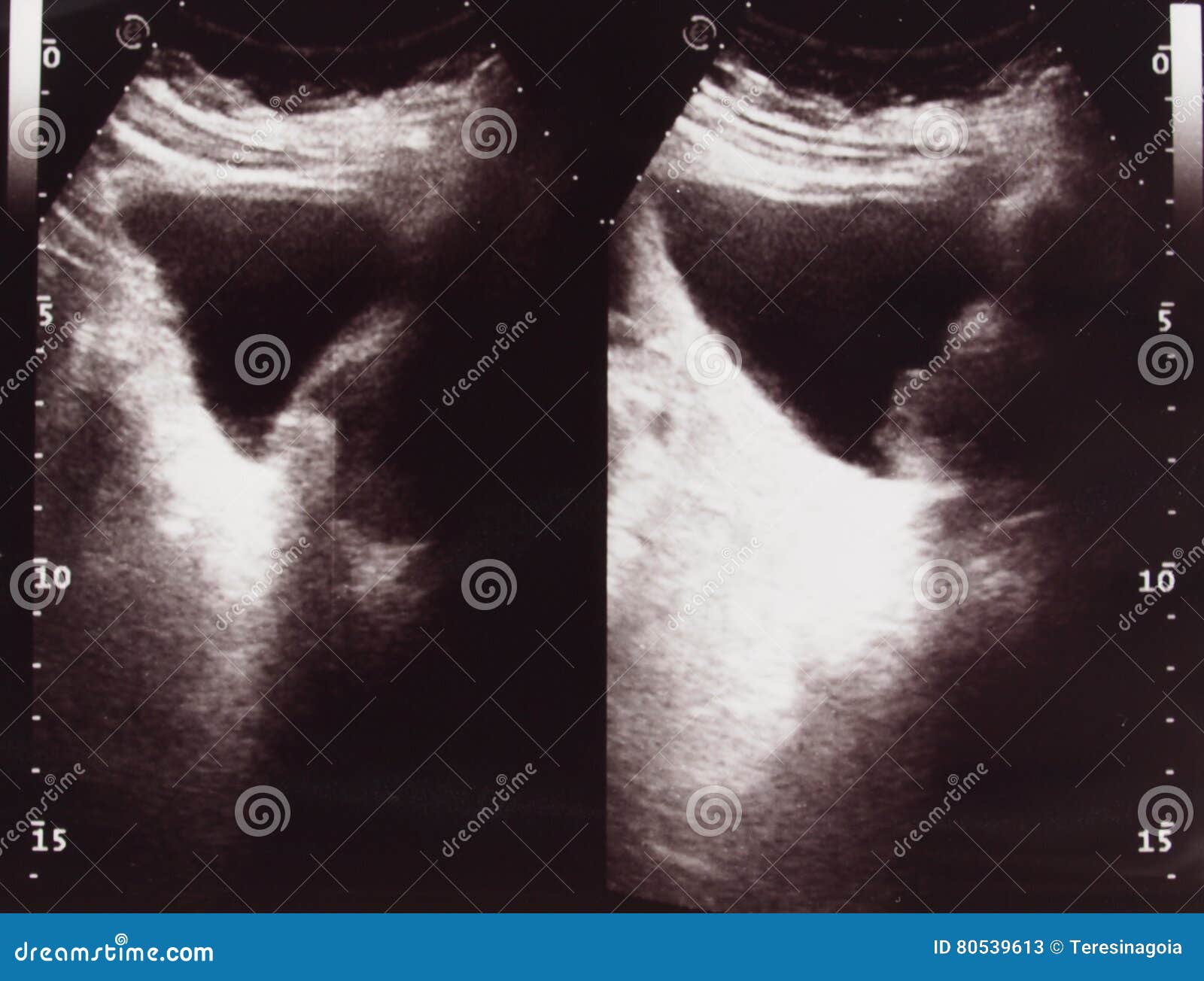 diagnostic sonography of abdomen