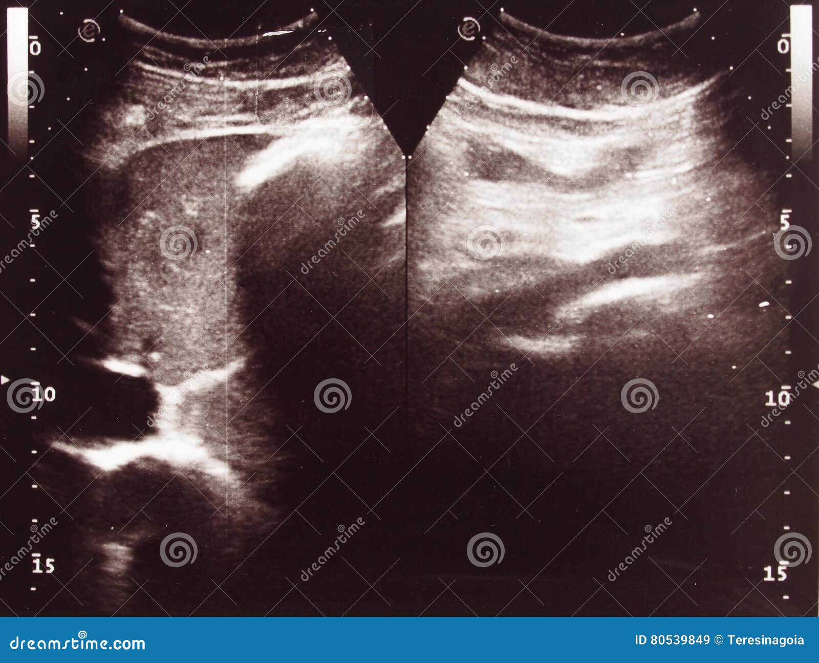 diagnostic sonography of abdomen