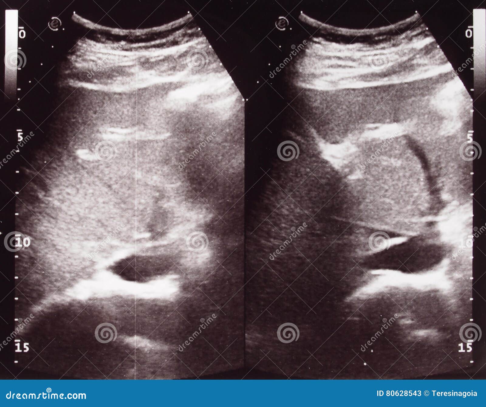 diagnostic sonography of abdomen