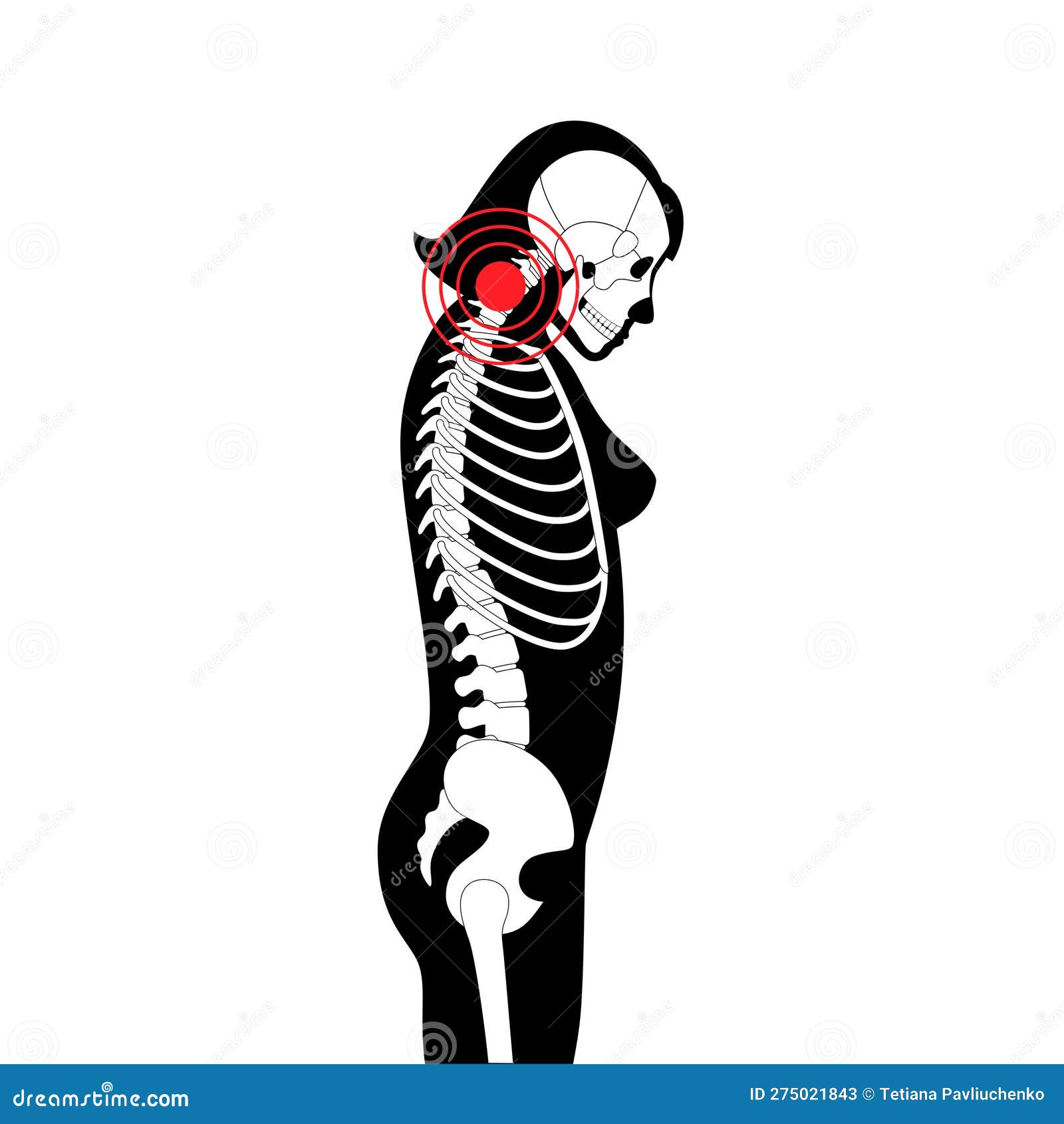 Neck Vertebrae Deformity Vector Illustration 275603118