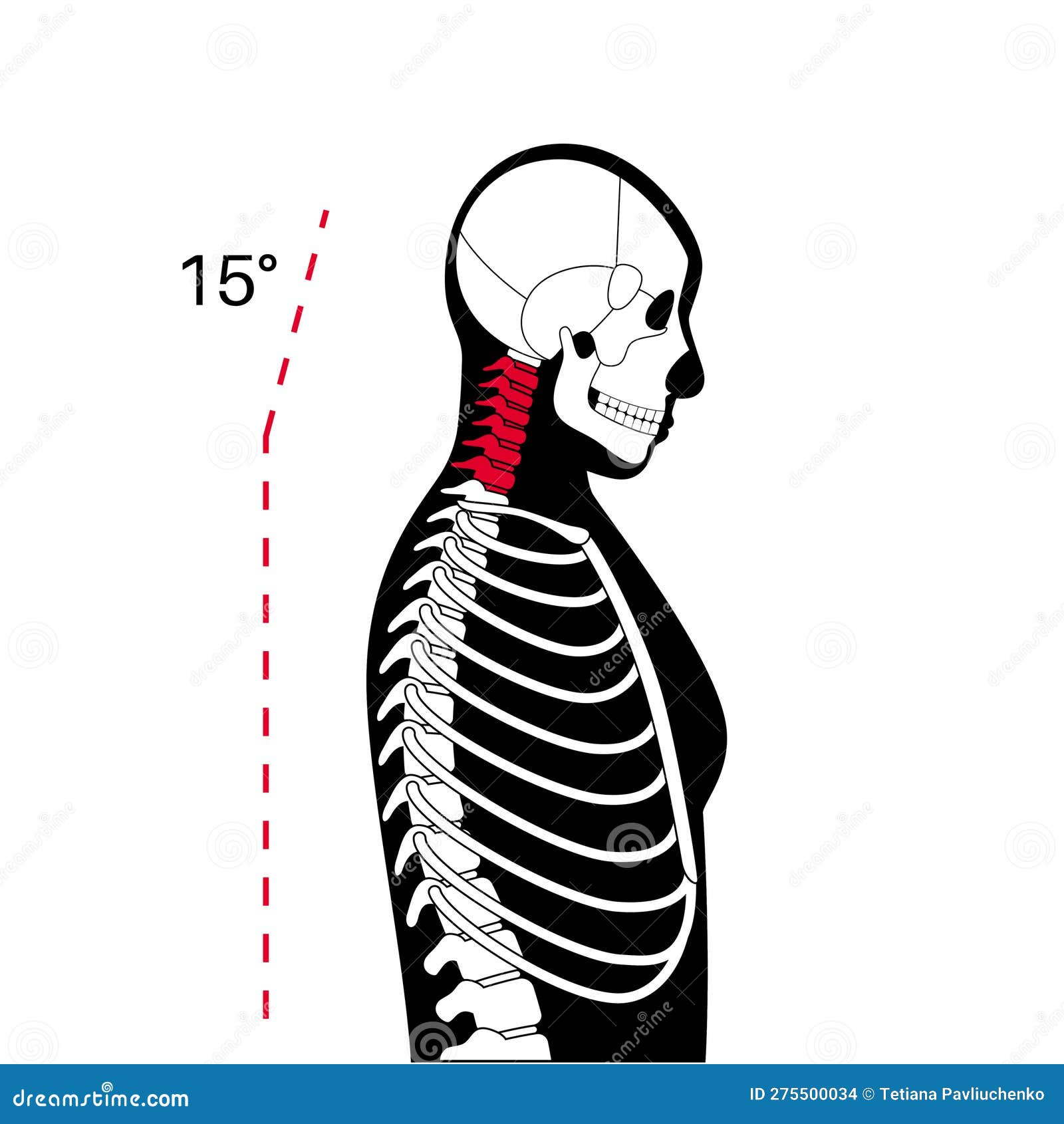 Neck vertebrae deformity stock vector. Illustration of chiropractor ...