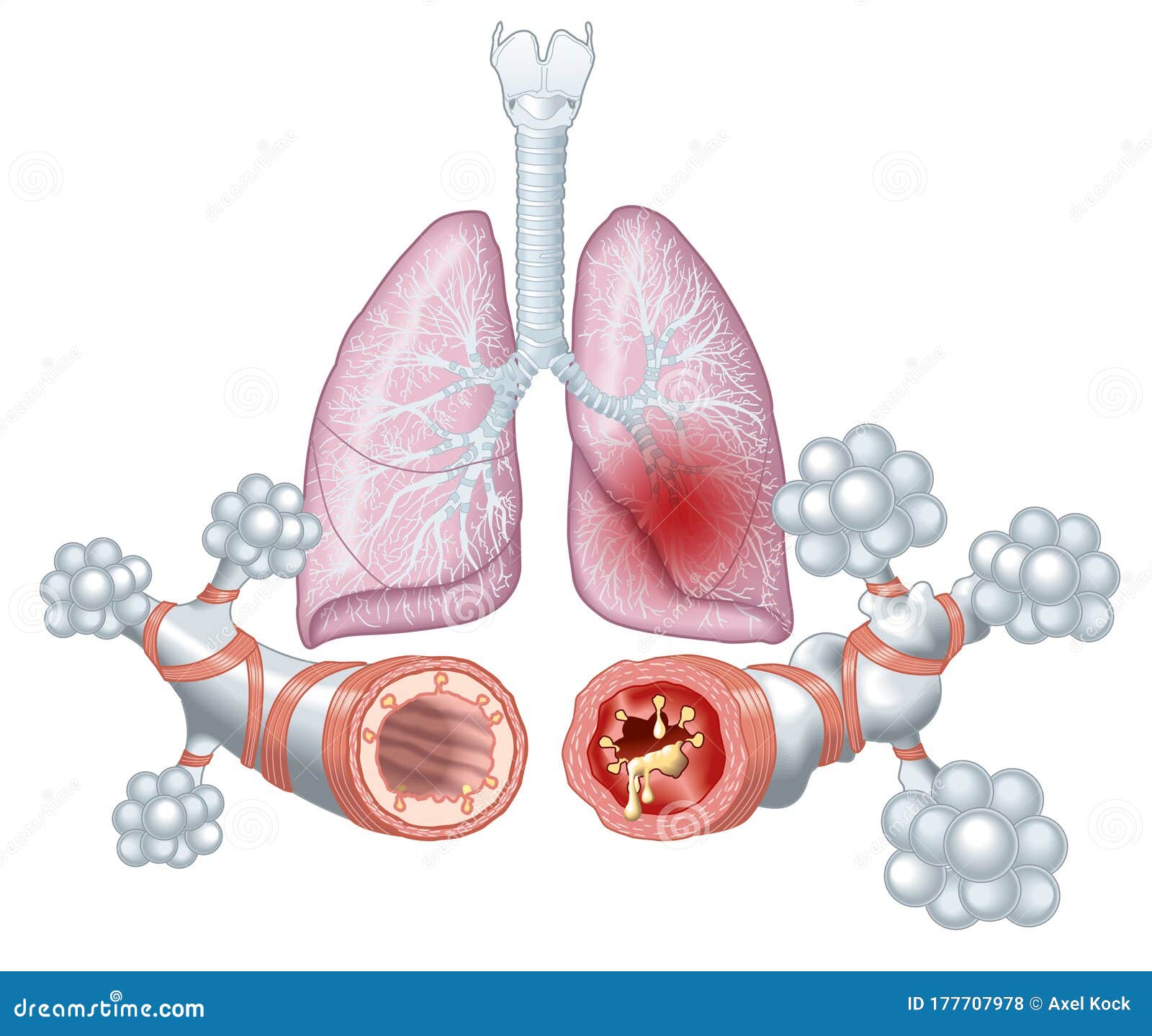 asthma, normal and asthmatic airways, medically 