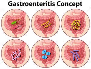 Gastroenteritis Vector Illustration CartoonDealer 72963888