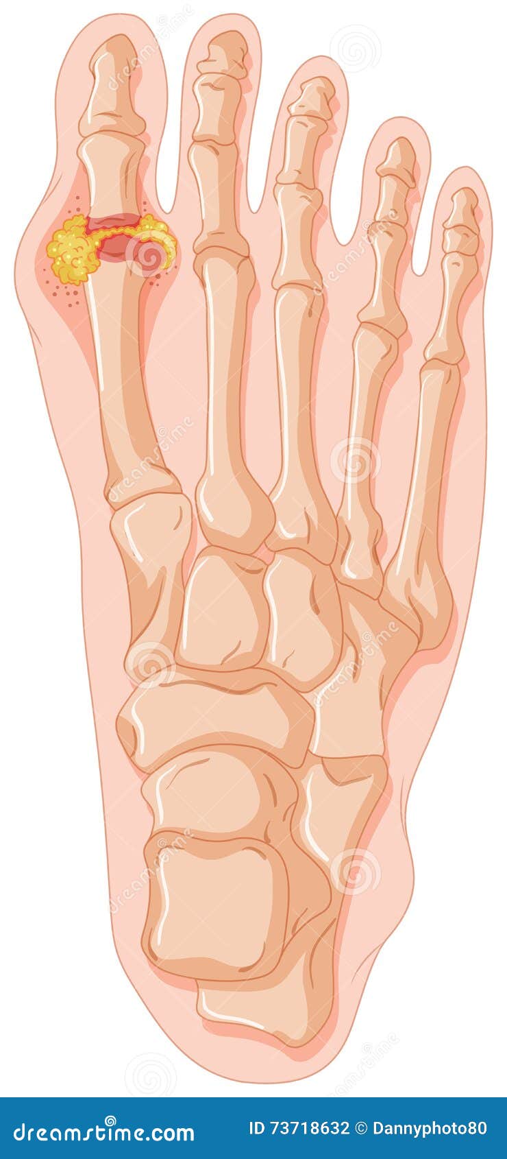 Diagram showing gout toe stock vector. Illustration of toes 73718632