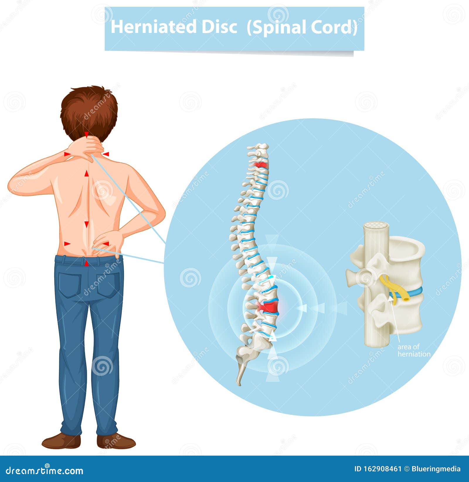 Diagram Showing Herniated Disc Stock Vector - Illustration of cartoon, male: 162908461 Diagram Showing Herniated Disc Stock Vector - Illustration of cartoon, male: 162908461