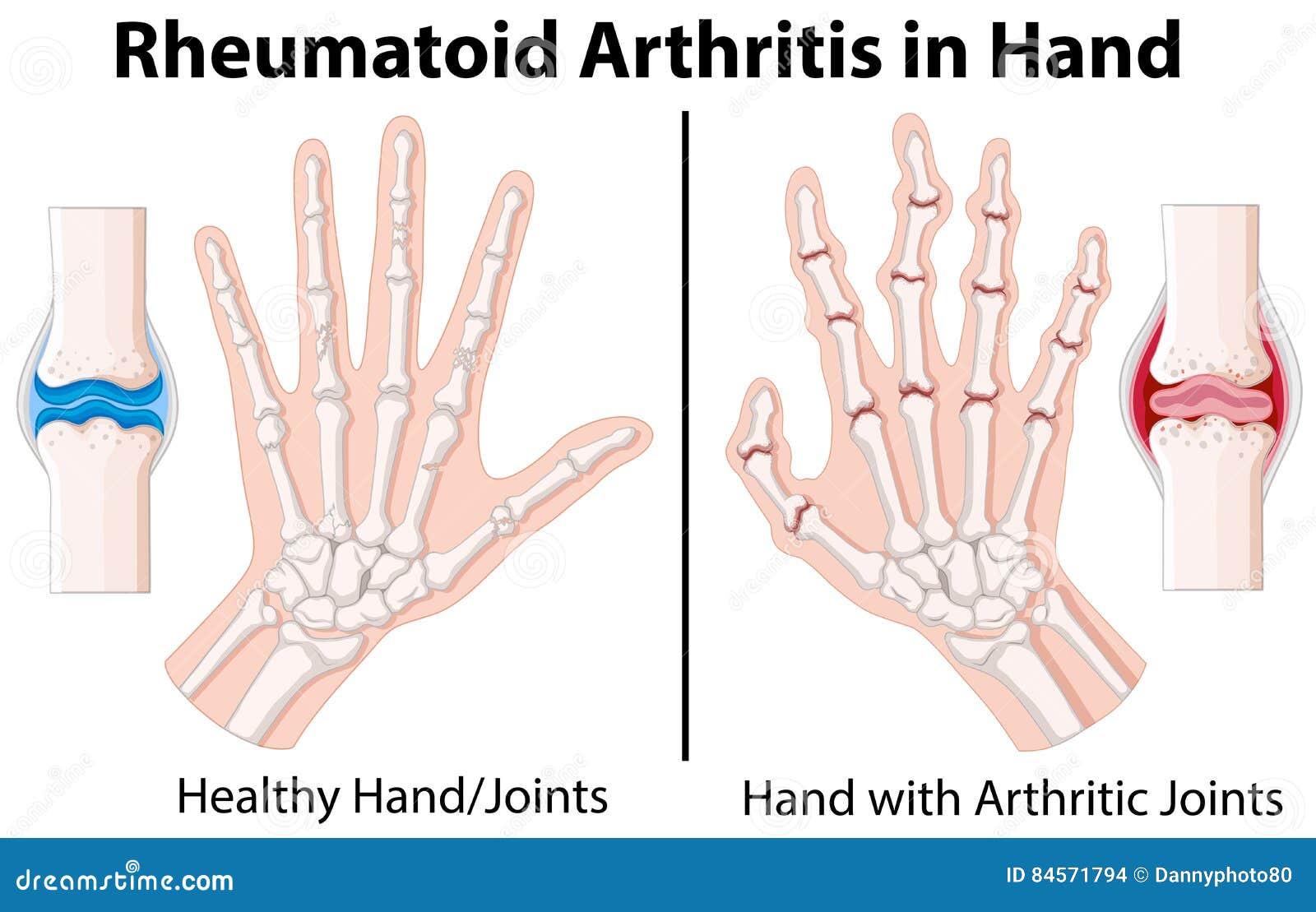 Rheumatoid Arthritis Chart